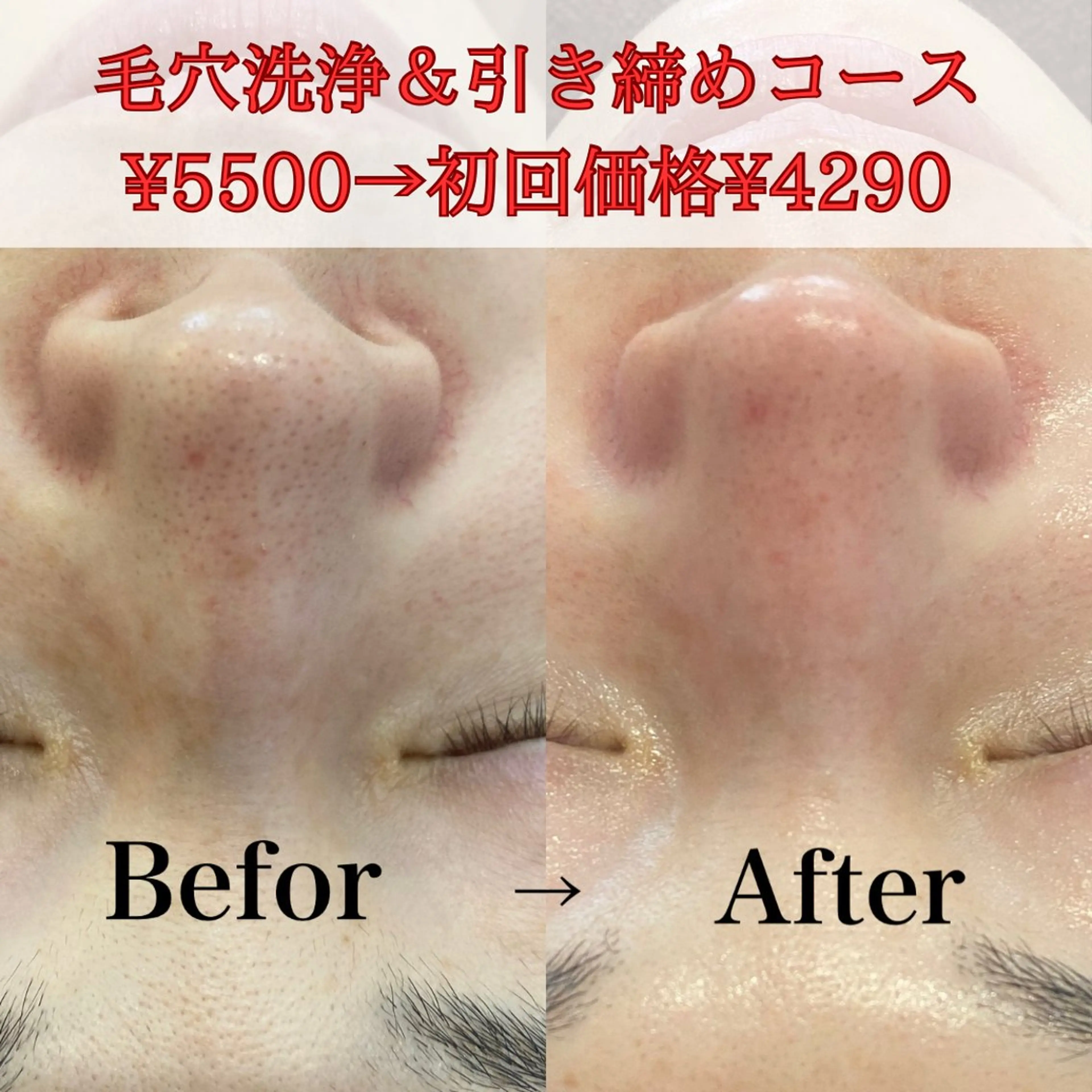 【初回お試し】毛穴洗浄&引き締めコース¥5500¥初回割引¥4290の写真