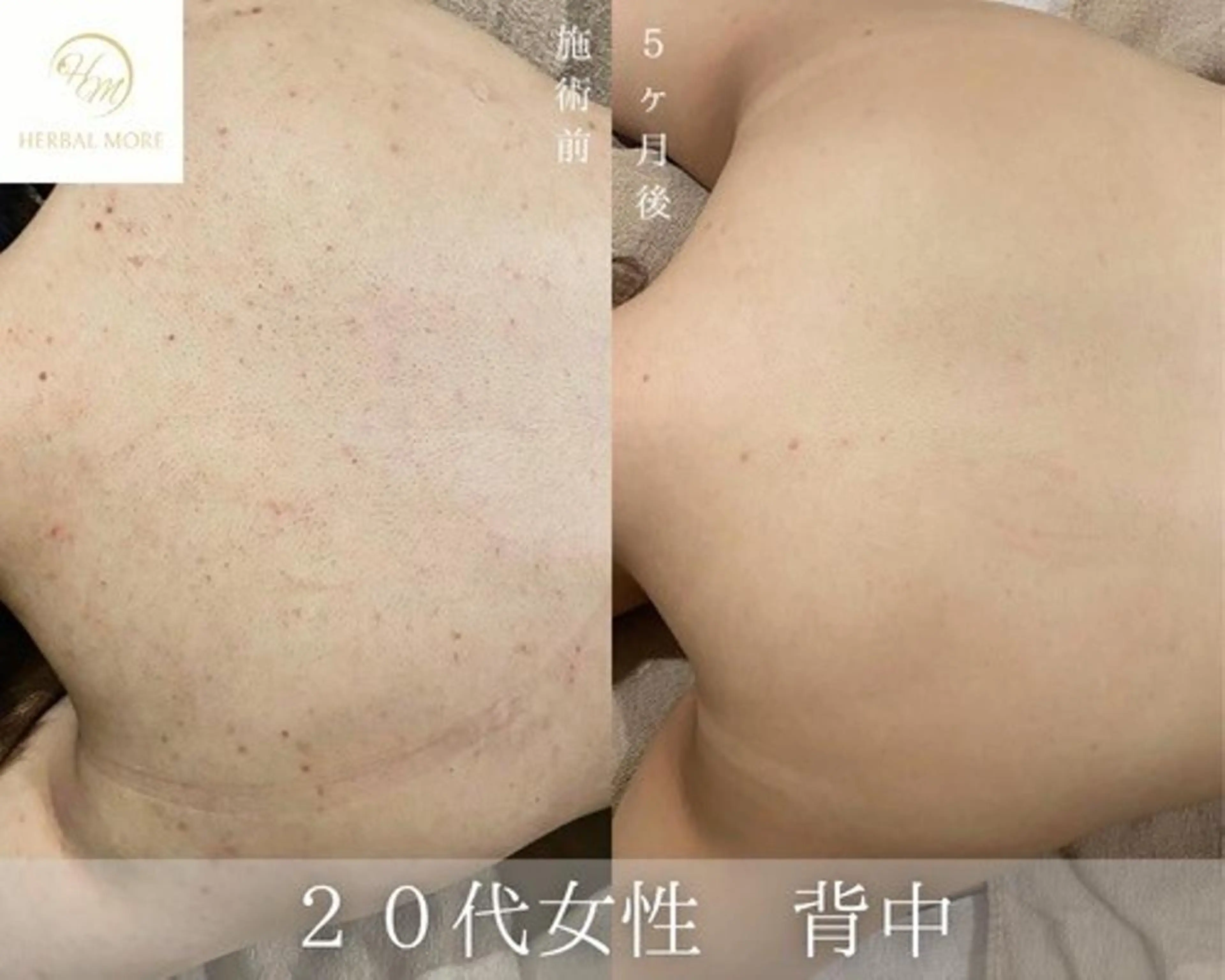 【美肌ケア背中ハーブピーリング✨】(皮むけなし💎)33,000→10,000円の写真