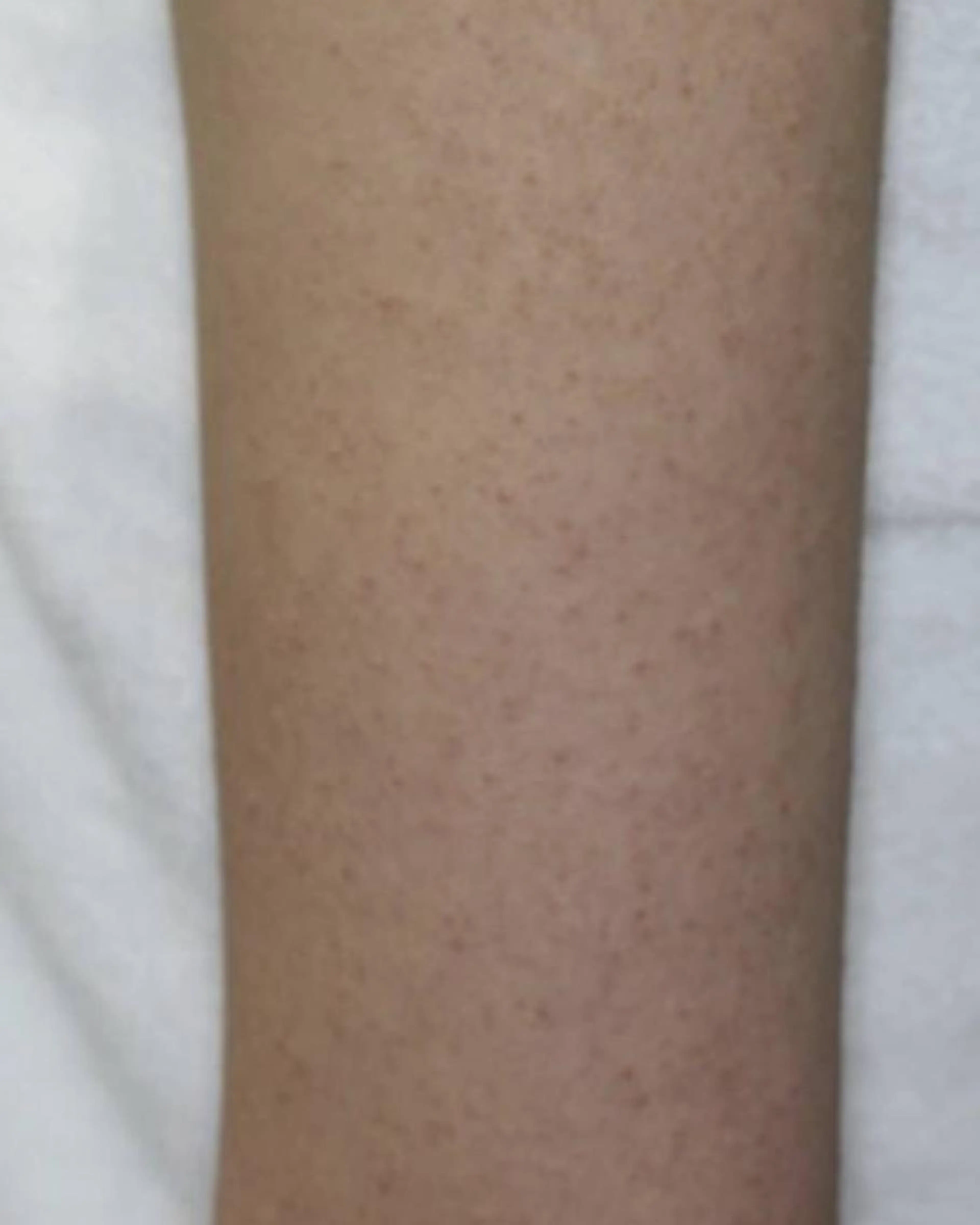 【二の腕ブツブツザラザラケア】剥けないハーブピーリング＋生酵素の写真