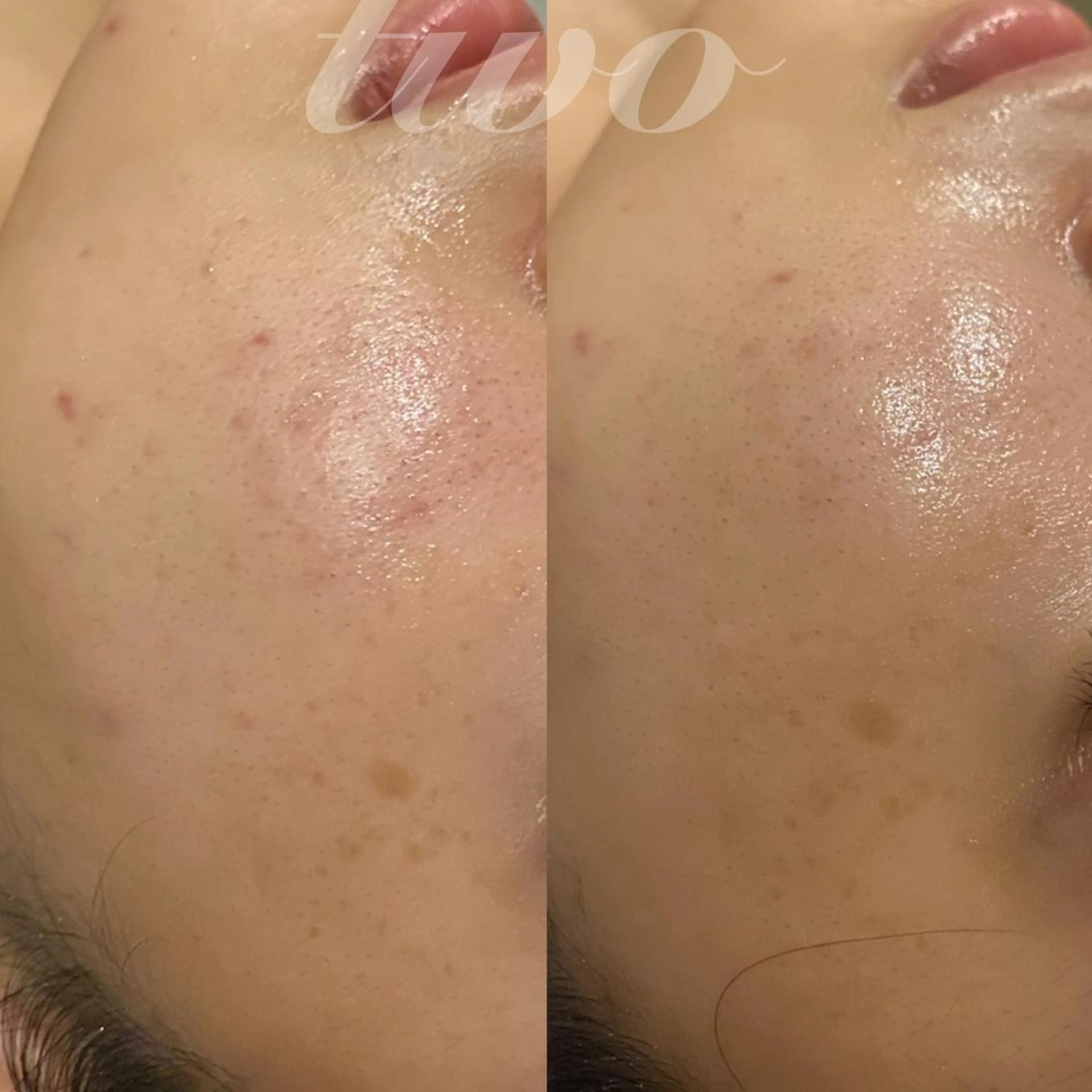 ハーブピーリング（顔）マッサージ無しの写真