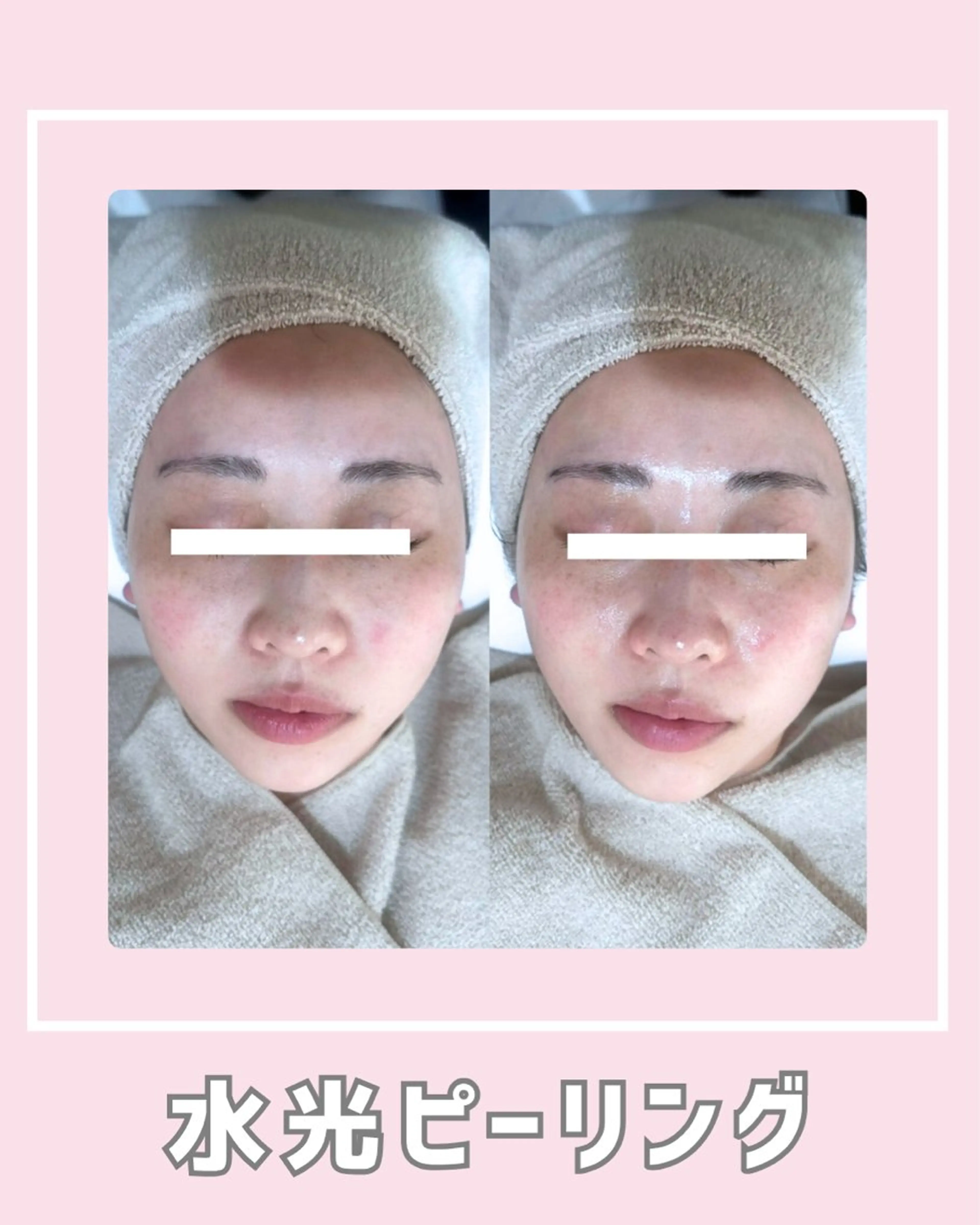 エステ |ピーリング・毛穴| soina神楽坂のエステ・リラクイメージ