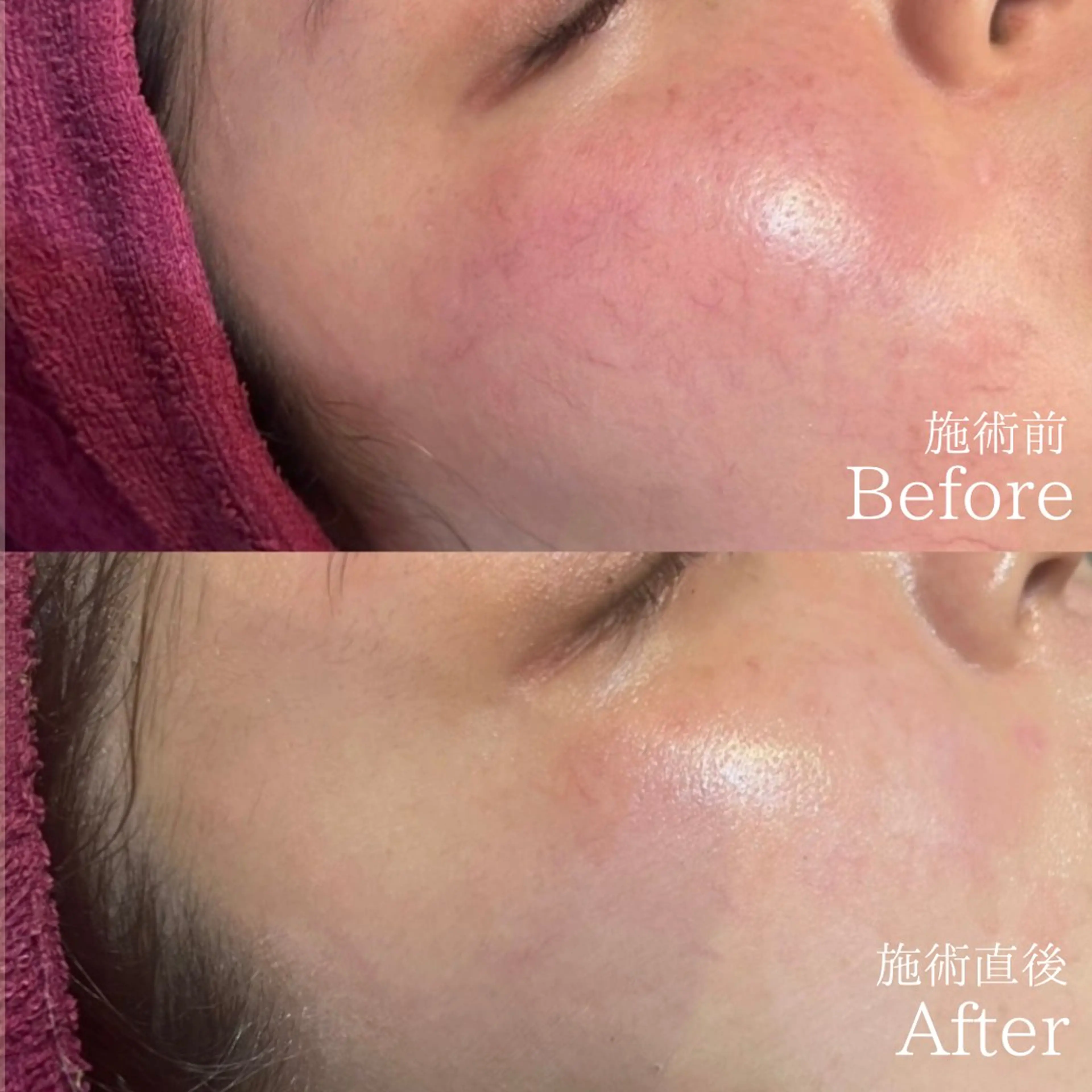 【毛穴・美白・ツヤ】韓国産🇰🇷剥離なしハーブピーリングの写真