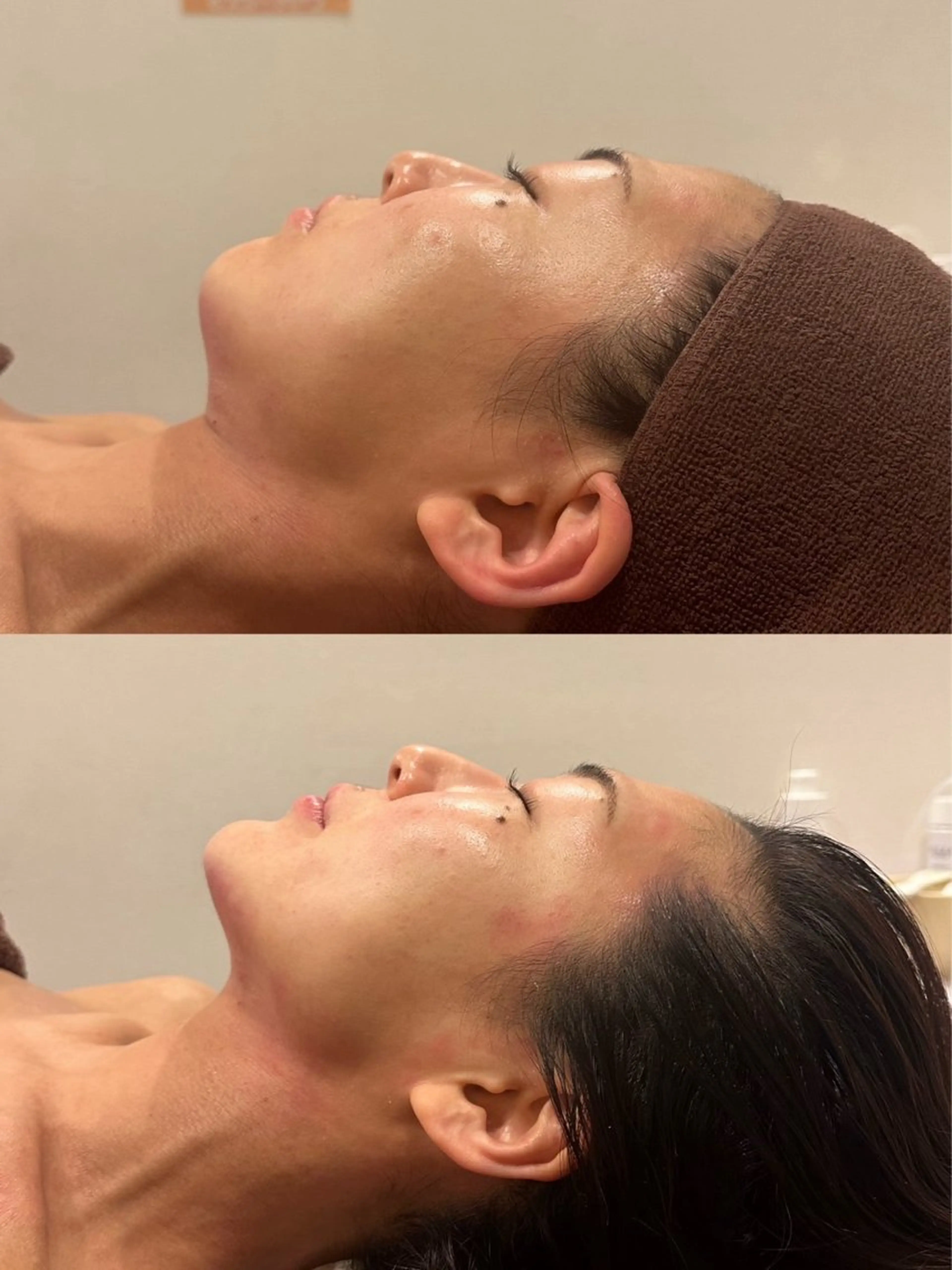 【美肌の基礎作り&お顔引き上げたい方はコレ★】エクソソーム＆泡パック造顔💖🔥の写真