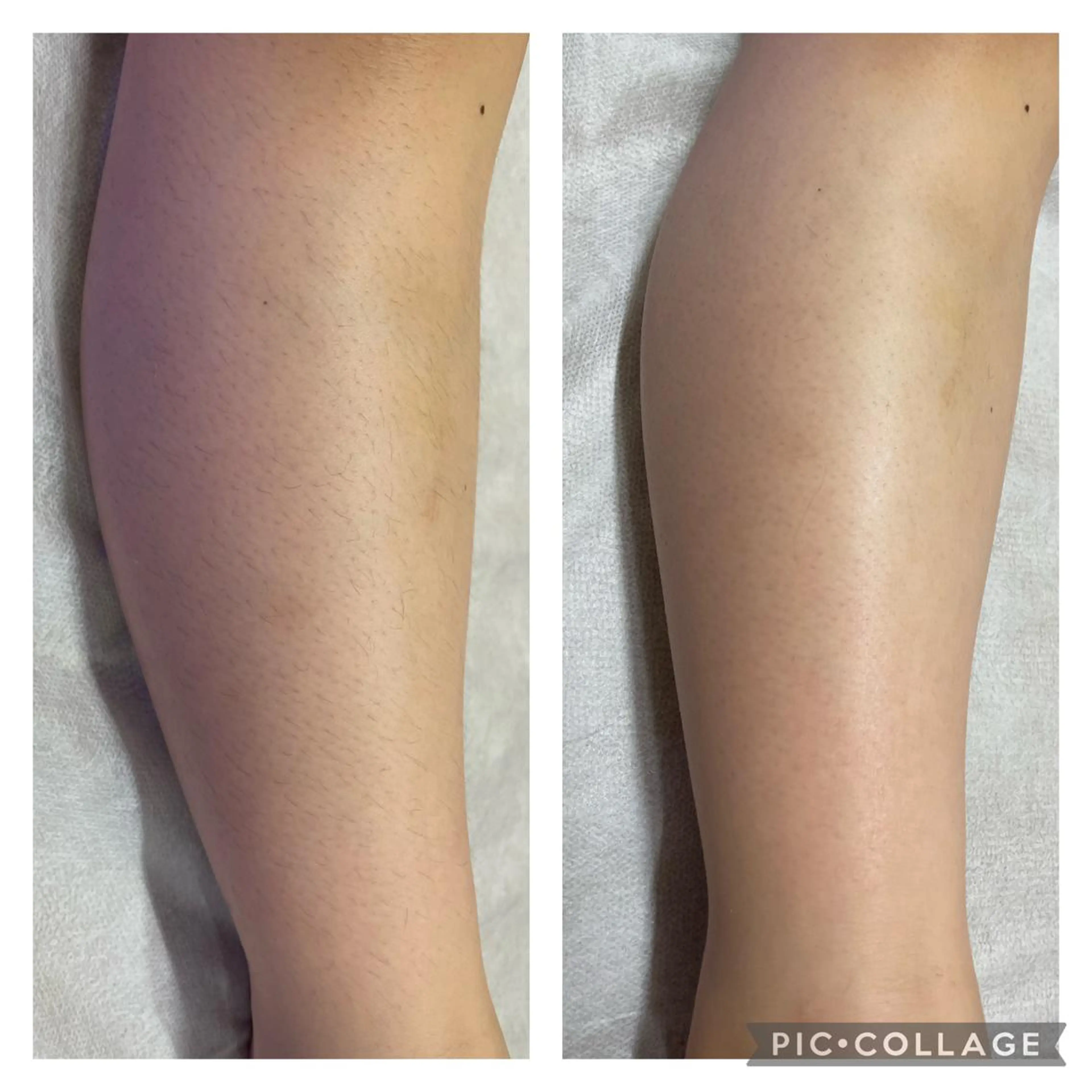 キッズ脱毛⭐️(7歳から13歳まで)3箇所¥2500の写真