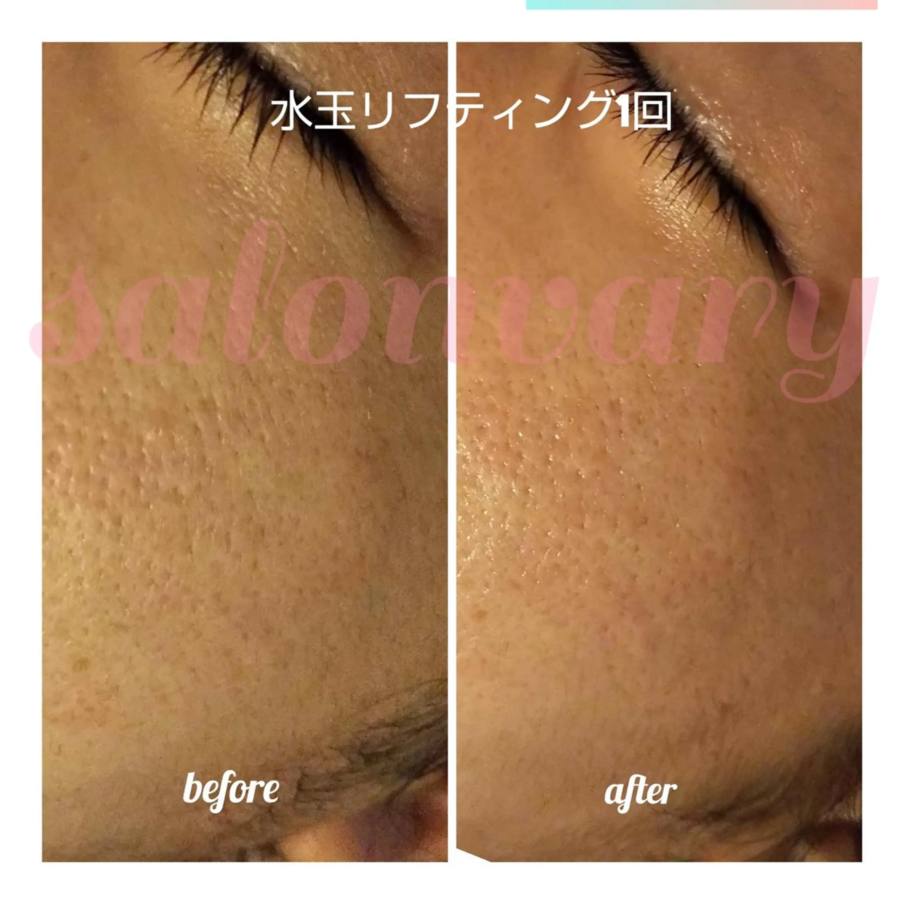 【ニキビ/肌管理】 salon varyのエステ・リラクイメージ