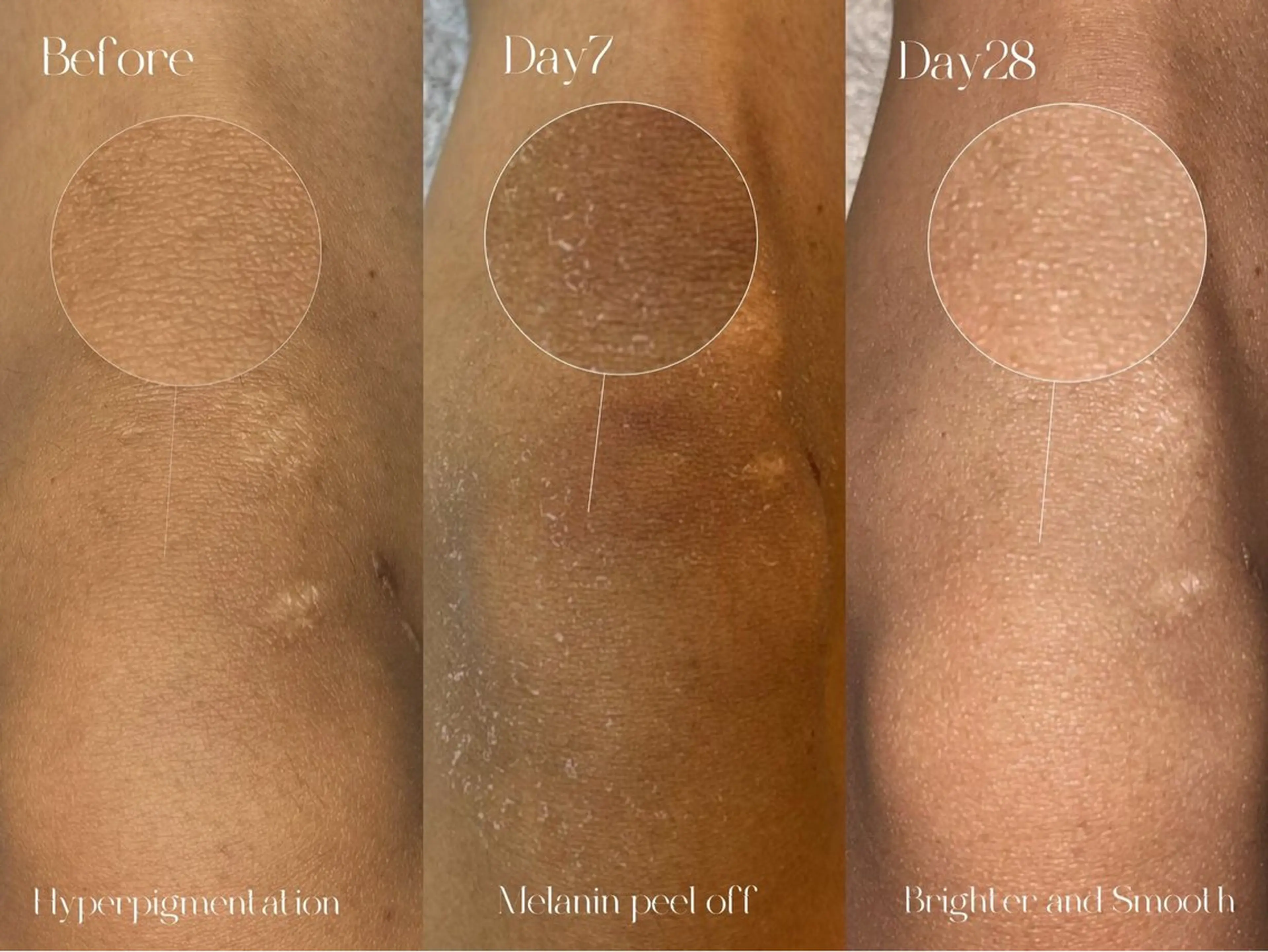 話題の最新黒ずみ除去【ローマピンク・ひじ又はひざ】　　　　　　　　モニター募集中！！40%オフの写真