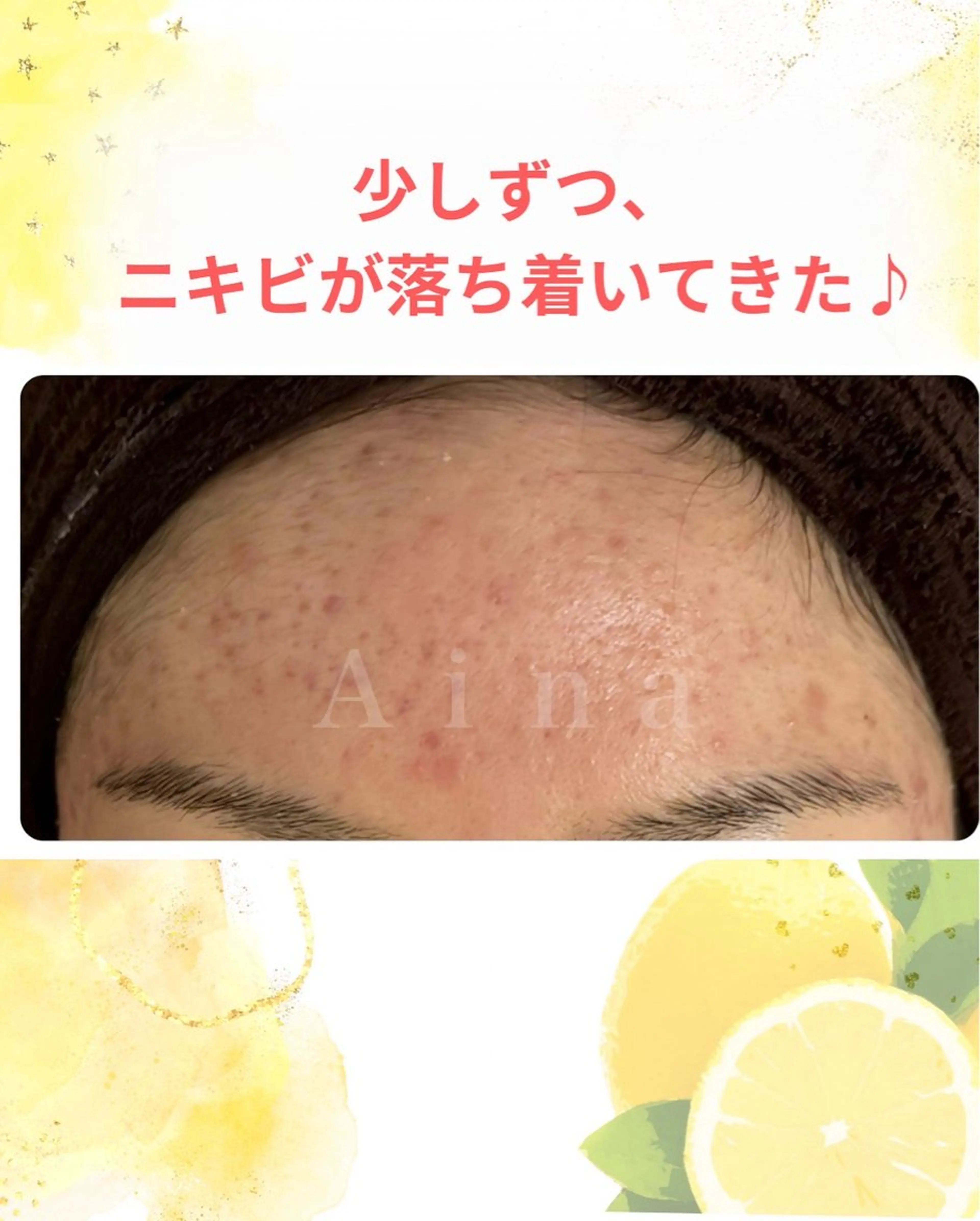 ニキビ跡専門サロン Ａｉｎａのエステ・リラクイメージ