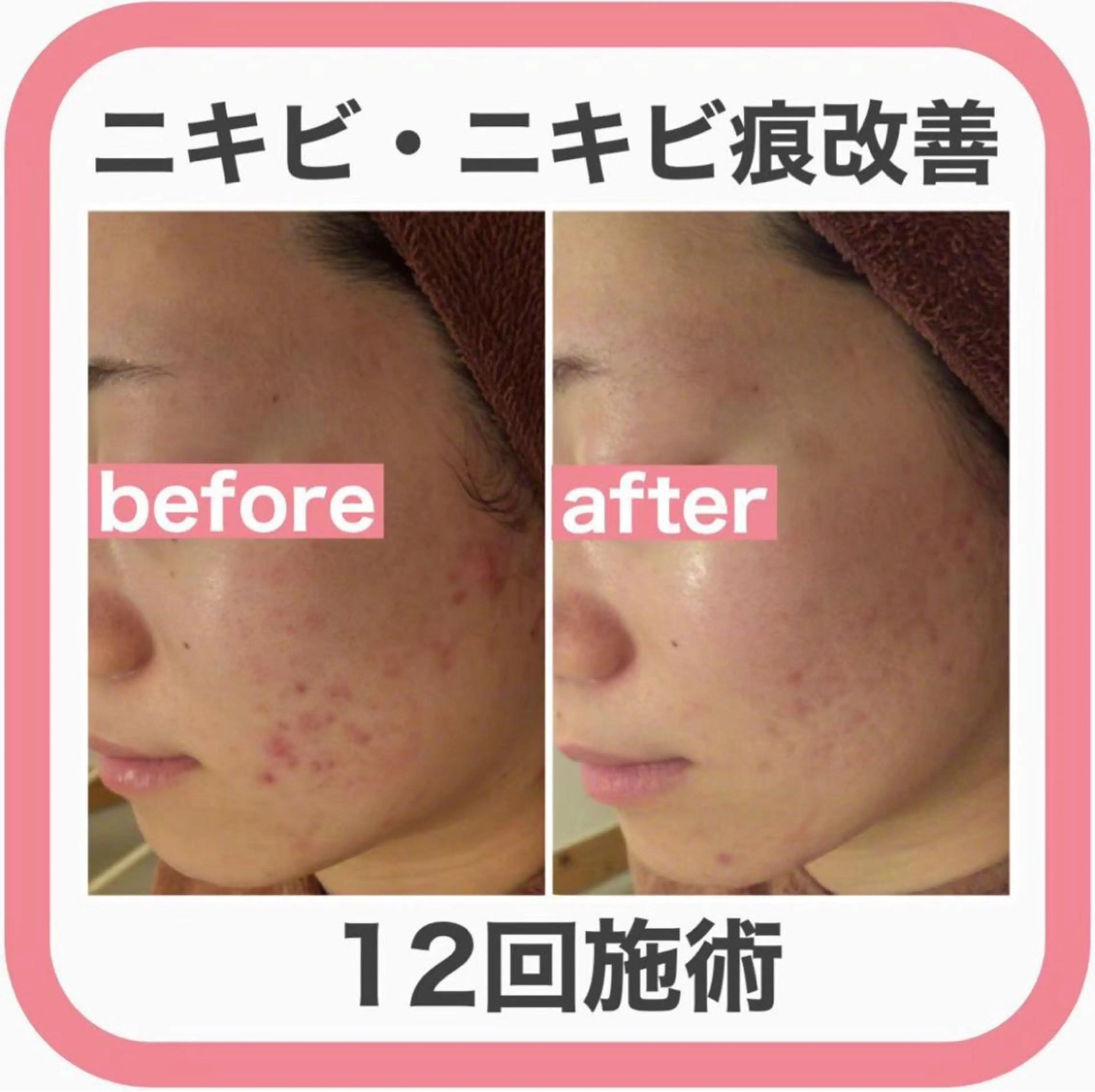 学生ニキビ改善🍀 優しい肌質改善のエステ・リラクイメージ