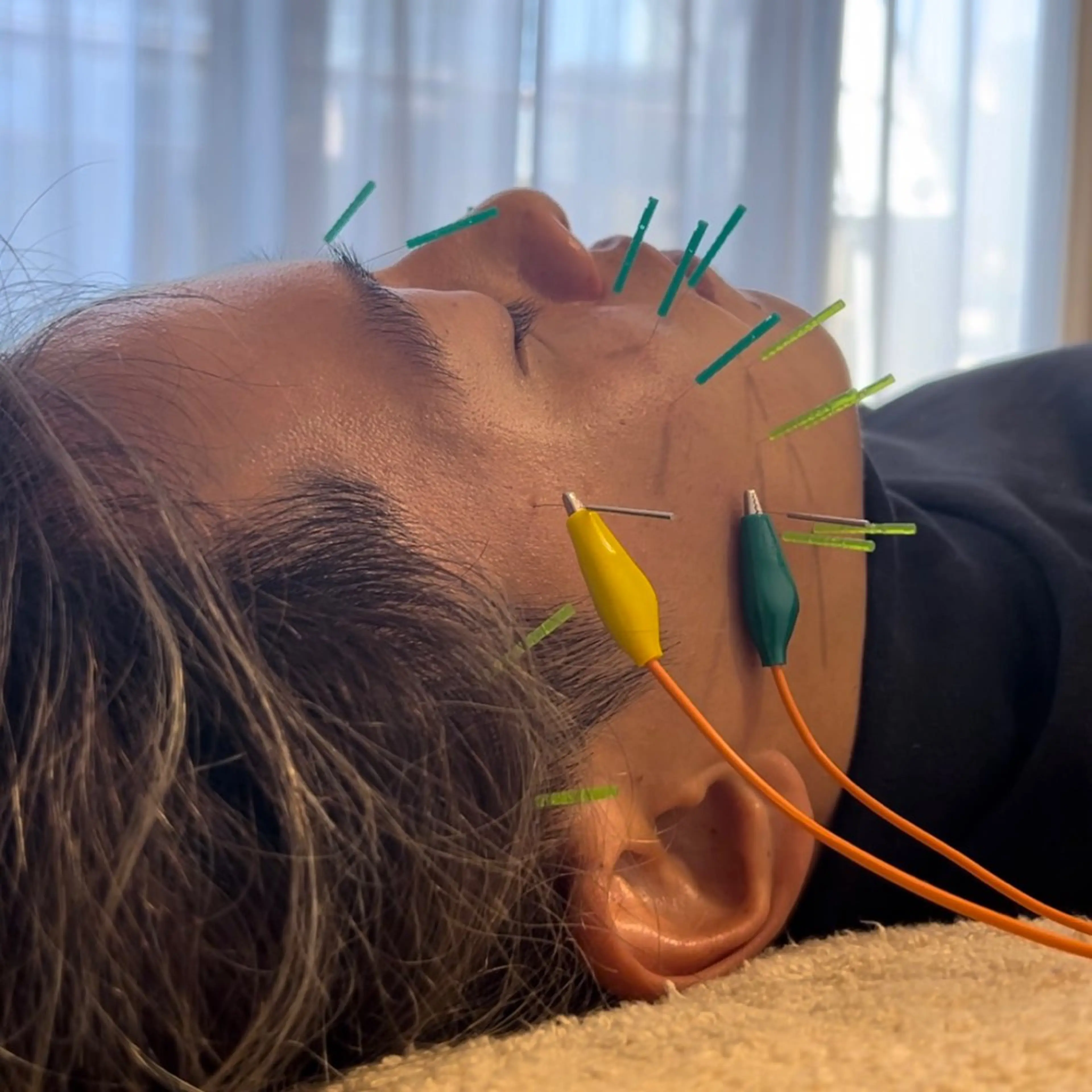 【✨リピーター✨】美容鍼+小顔矯正(70分)の写真