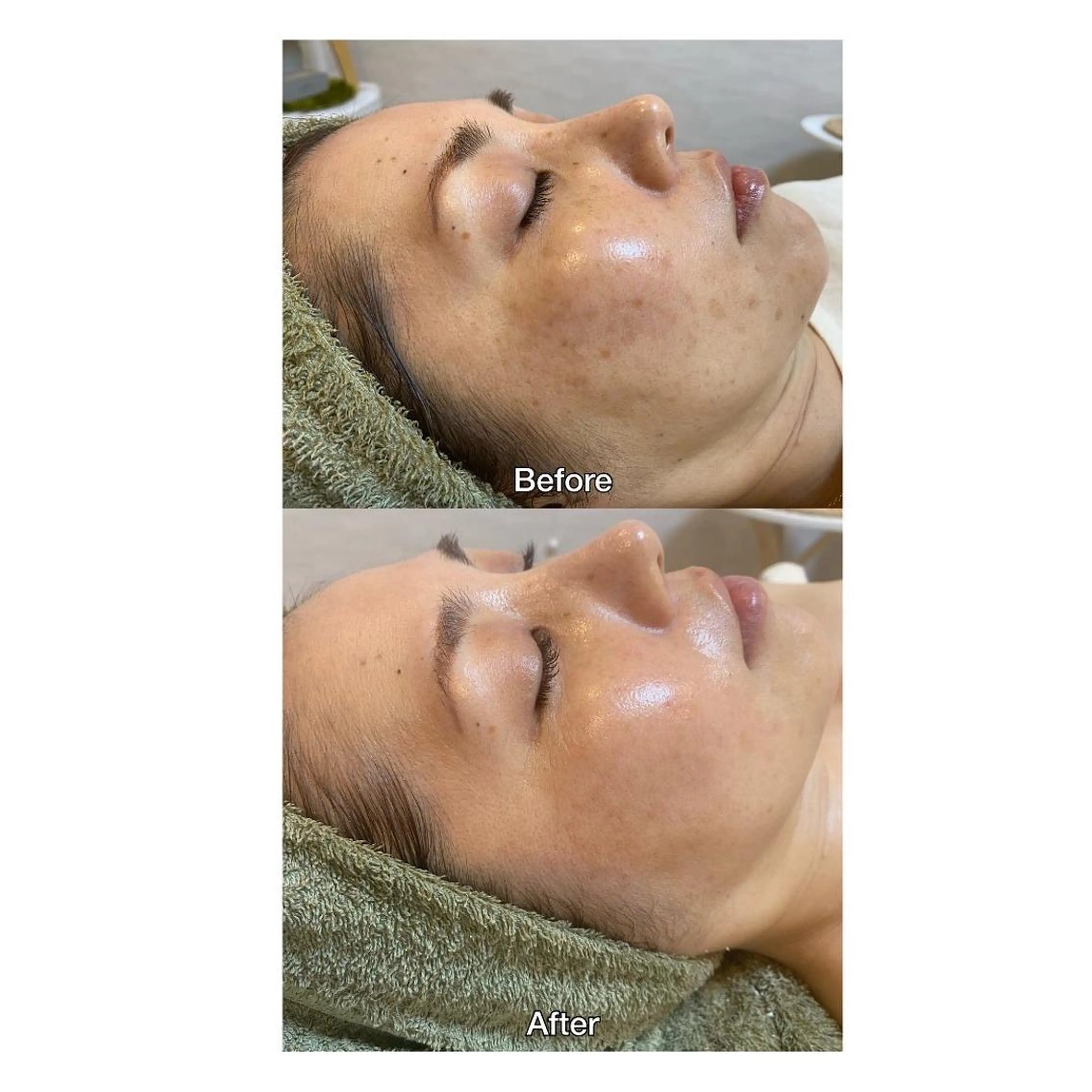 その他 脱毛｜ピーリング ROOM.Sのエステ・リラクイメージ