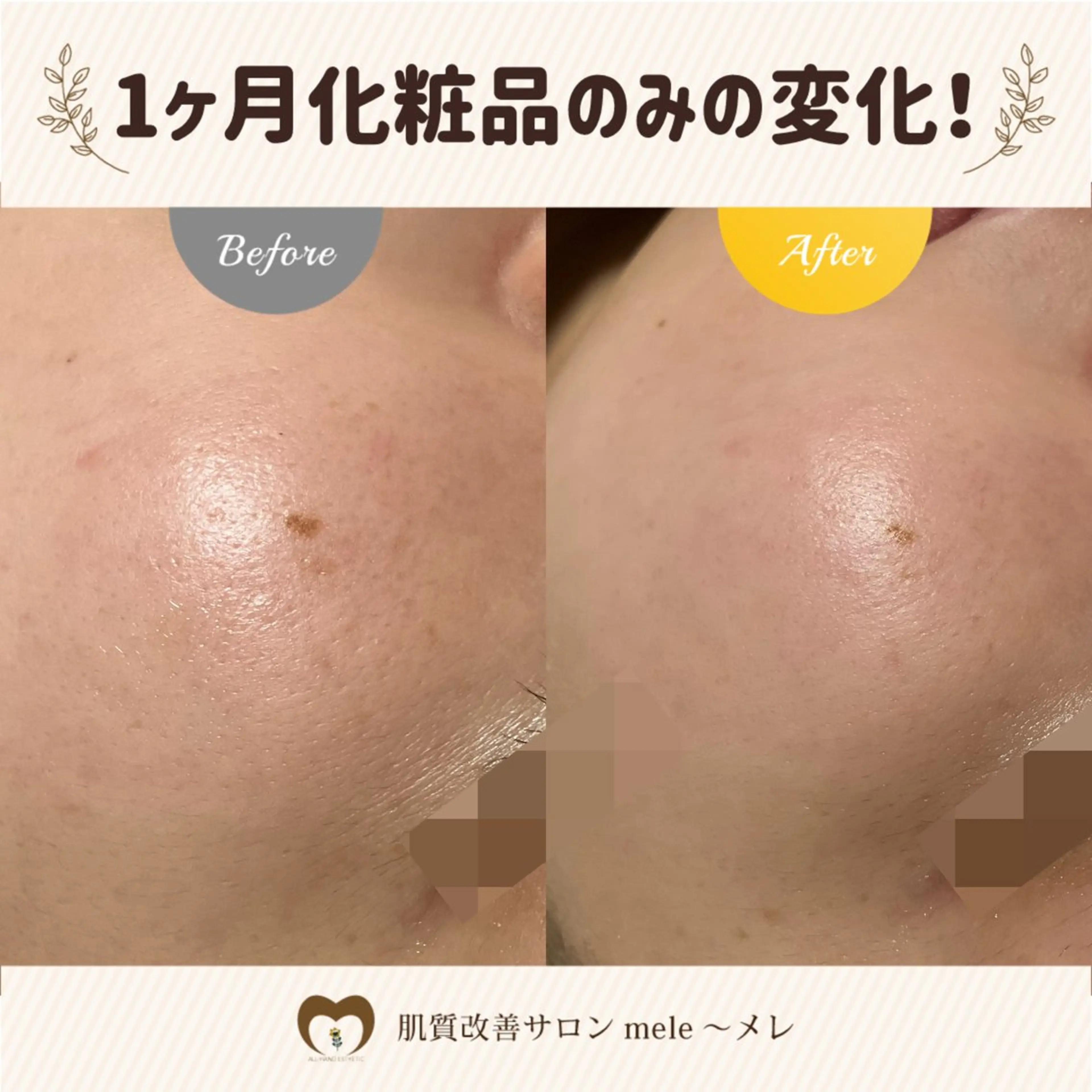 エステ リラク ニキビケア/毛穴/ 赤み/自信の肌✨森園のエステ・リラクイメージ