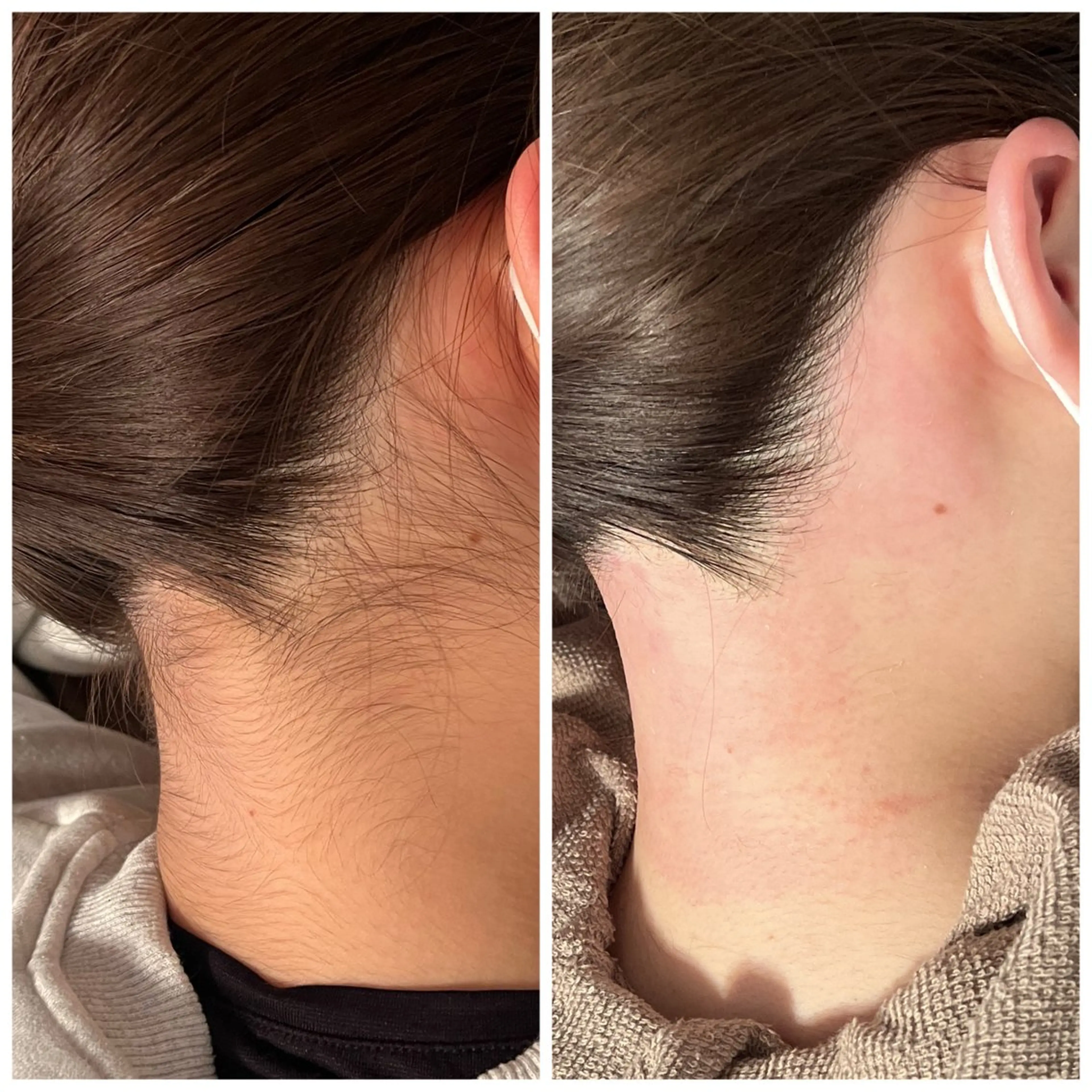 脱毛 Ｂ&H所属・頭痛•肩こり専門/ 眉サロンB&H心斎橋のエステ・リラクイメージ