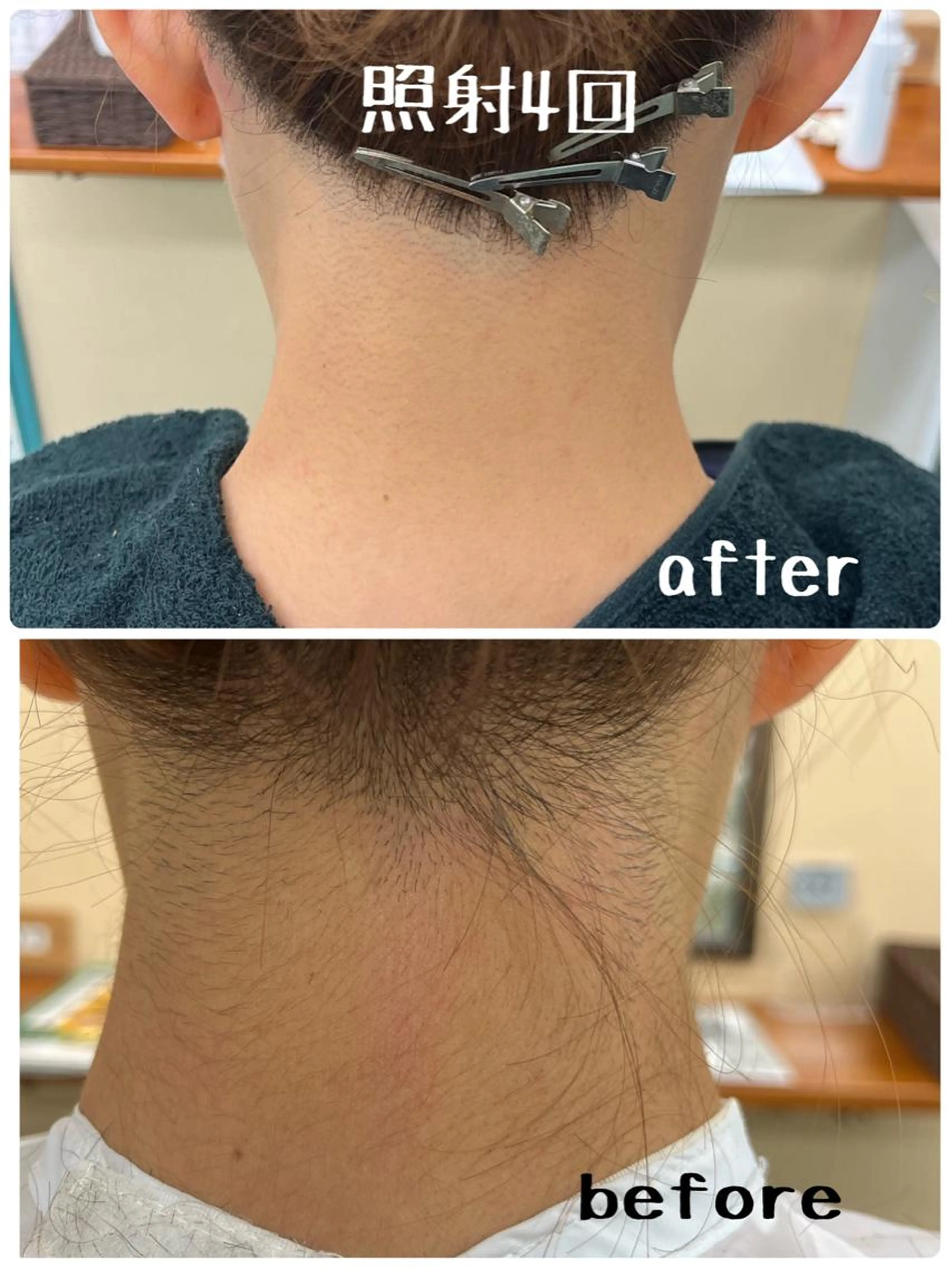 目指せうなじ美人 ❣️ 襟足脱毛  自分では気付かないが意外と人に見られているうなじ…綺麗にしませんか？の写真