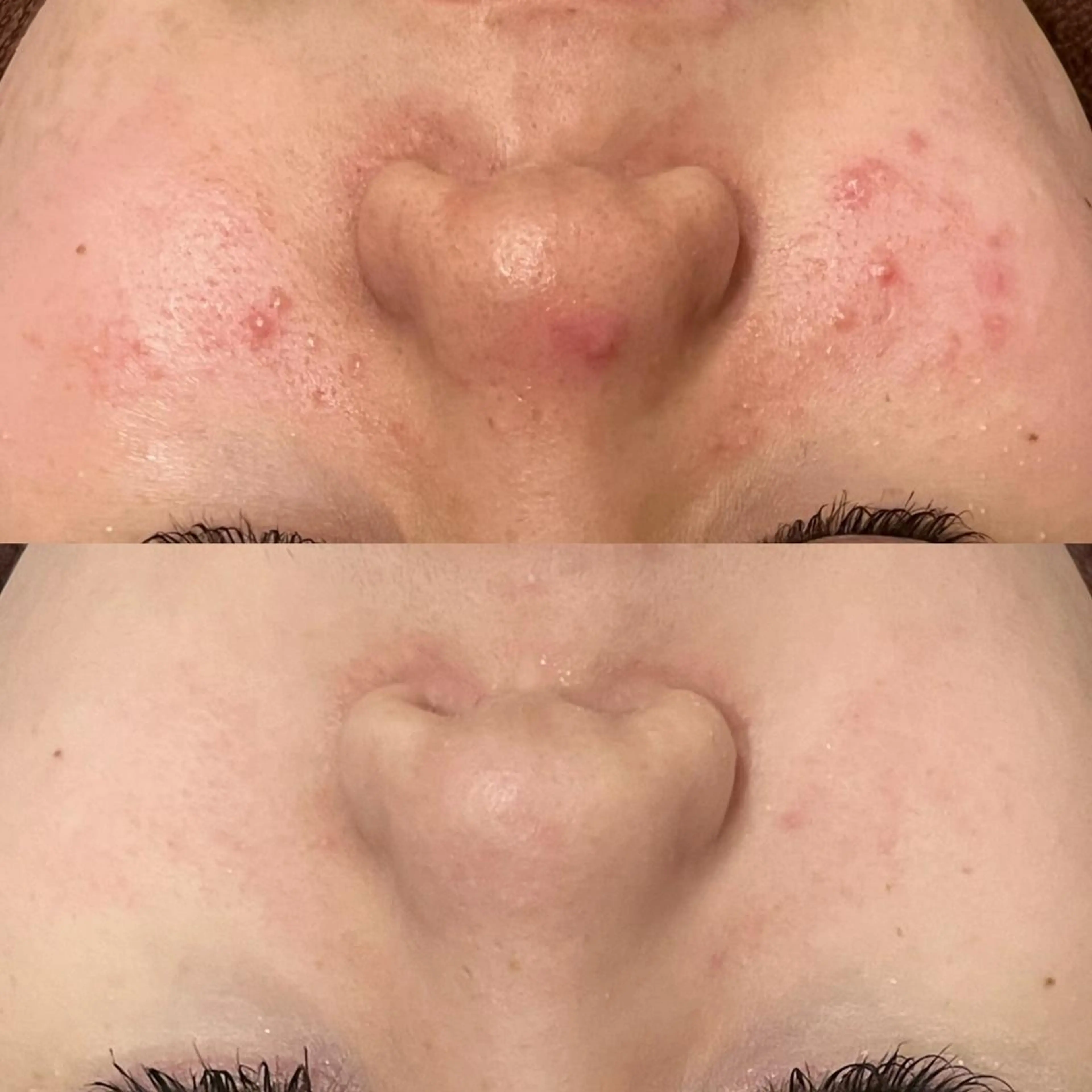 ダウンタイムなし🌷 優しいニキビ跡改善のエステ・リラクイメージ