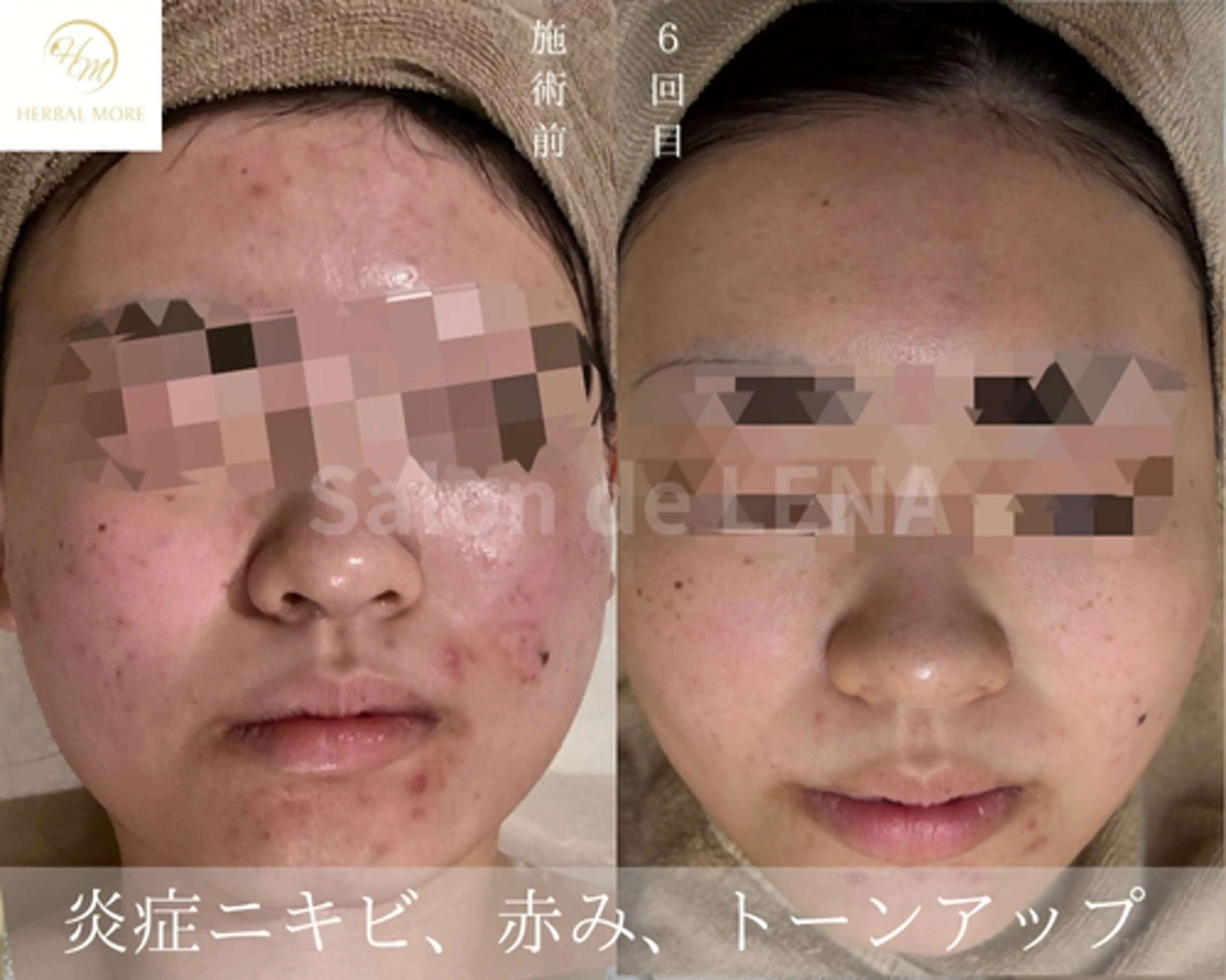 エステ サロンドレナ名駅店所属・ハーブピーリング専門 サロンドレナ平岡のエステ・リラクイメージ