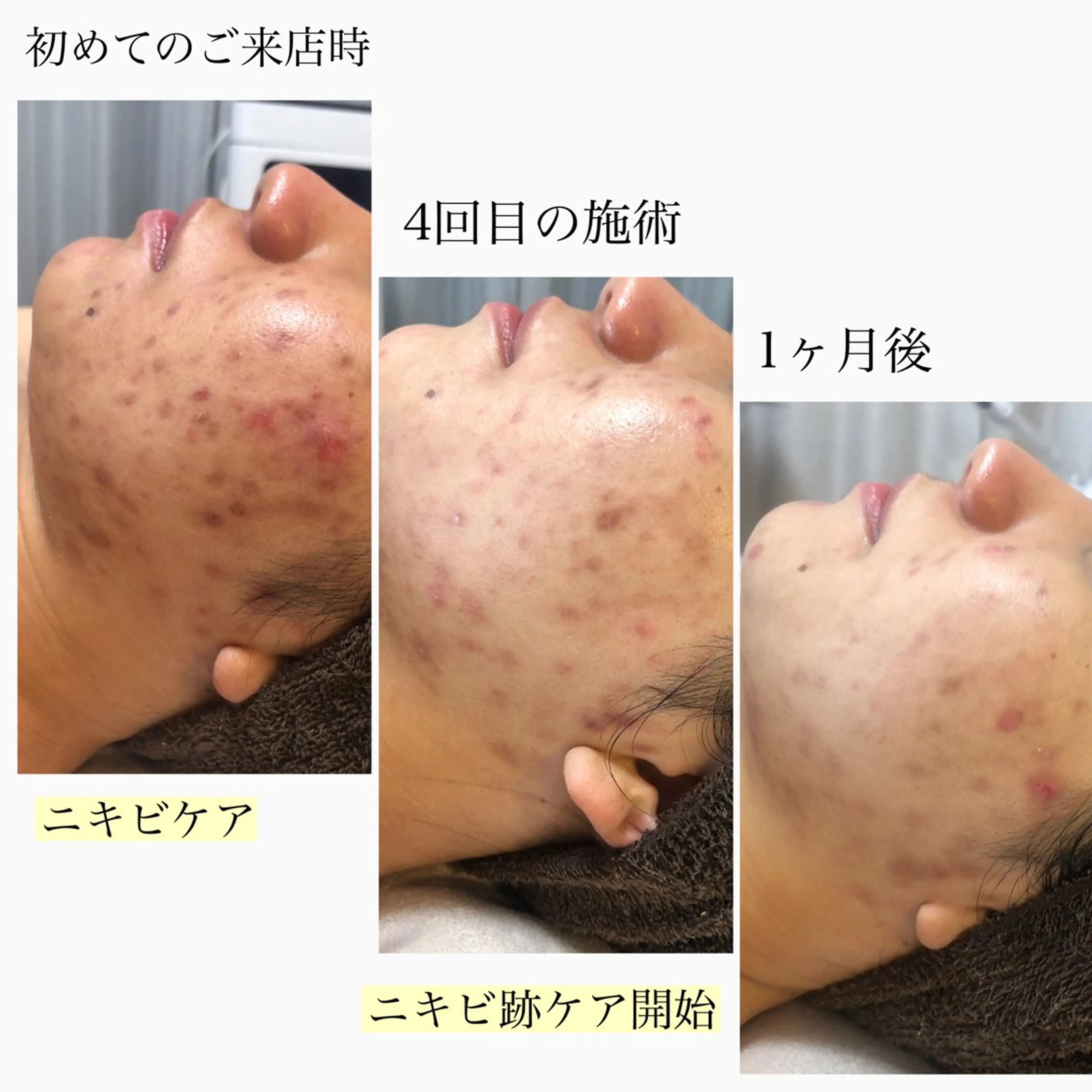 【ニキビ/肌荒れ/毛穴開きで悩んでる方】光フォト＋バクテリウムピールSET★シミ/しわ/ニキビ/ニキビ跡/赤ら顔の写真