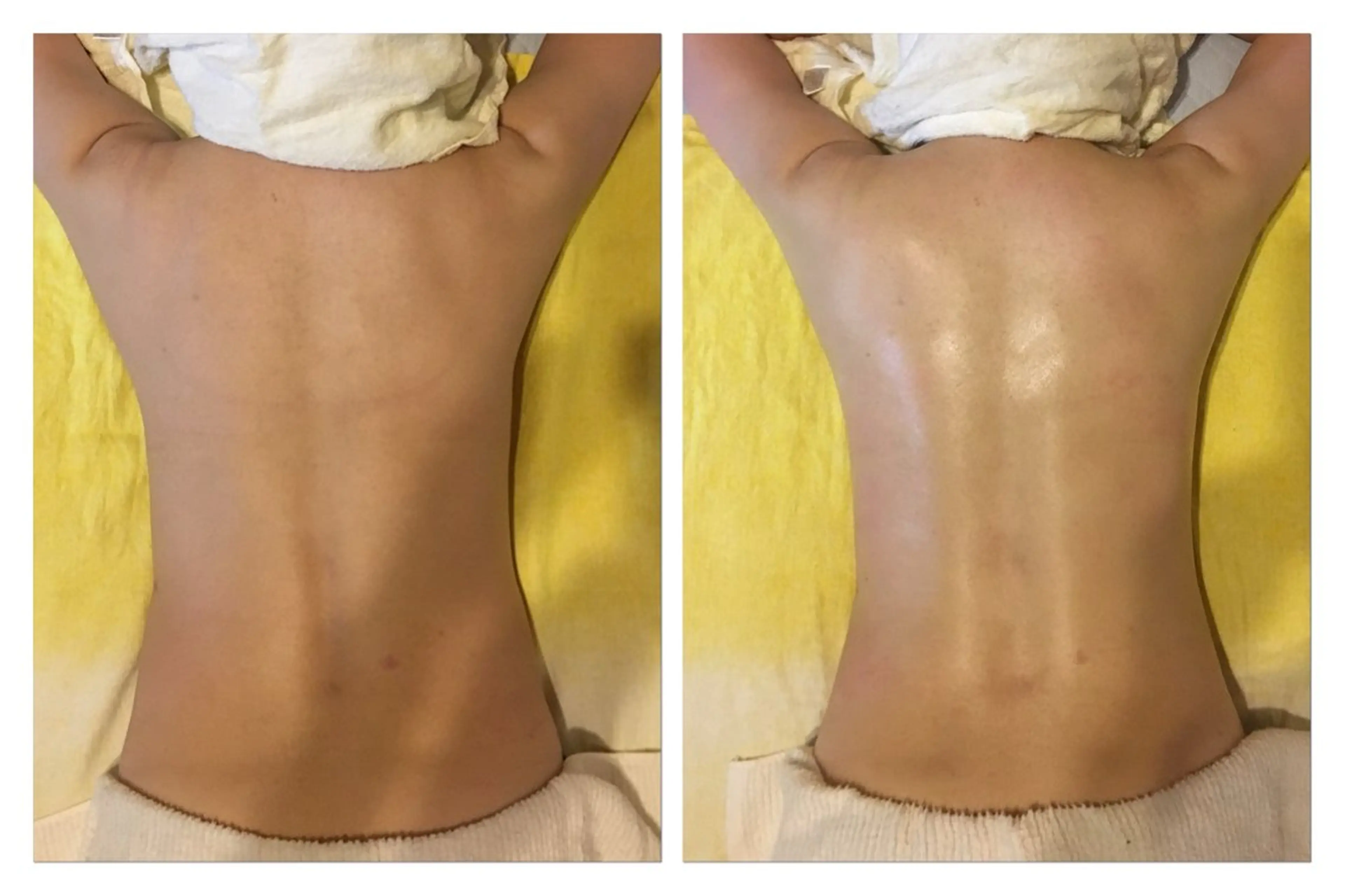 お試し背中ケア（セル脂肪ケア➕リンパドレナージュ）の写真