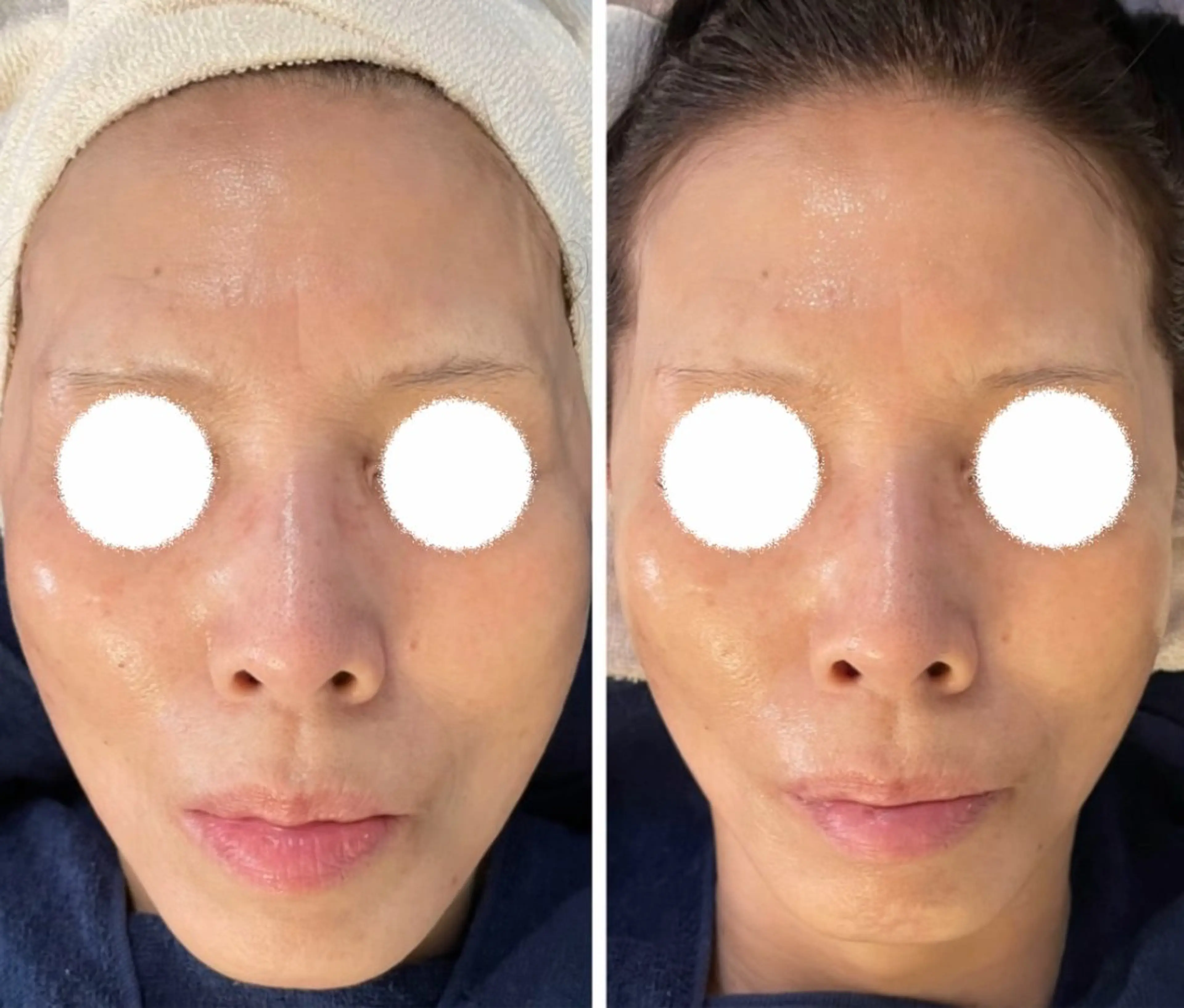 ㊗️周年記念‼️究極小顔コース【1回】 ¥39,600→33,000の写真