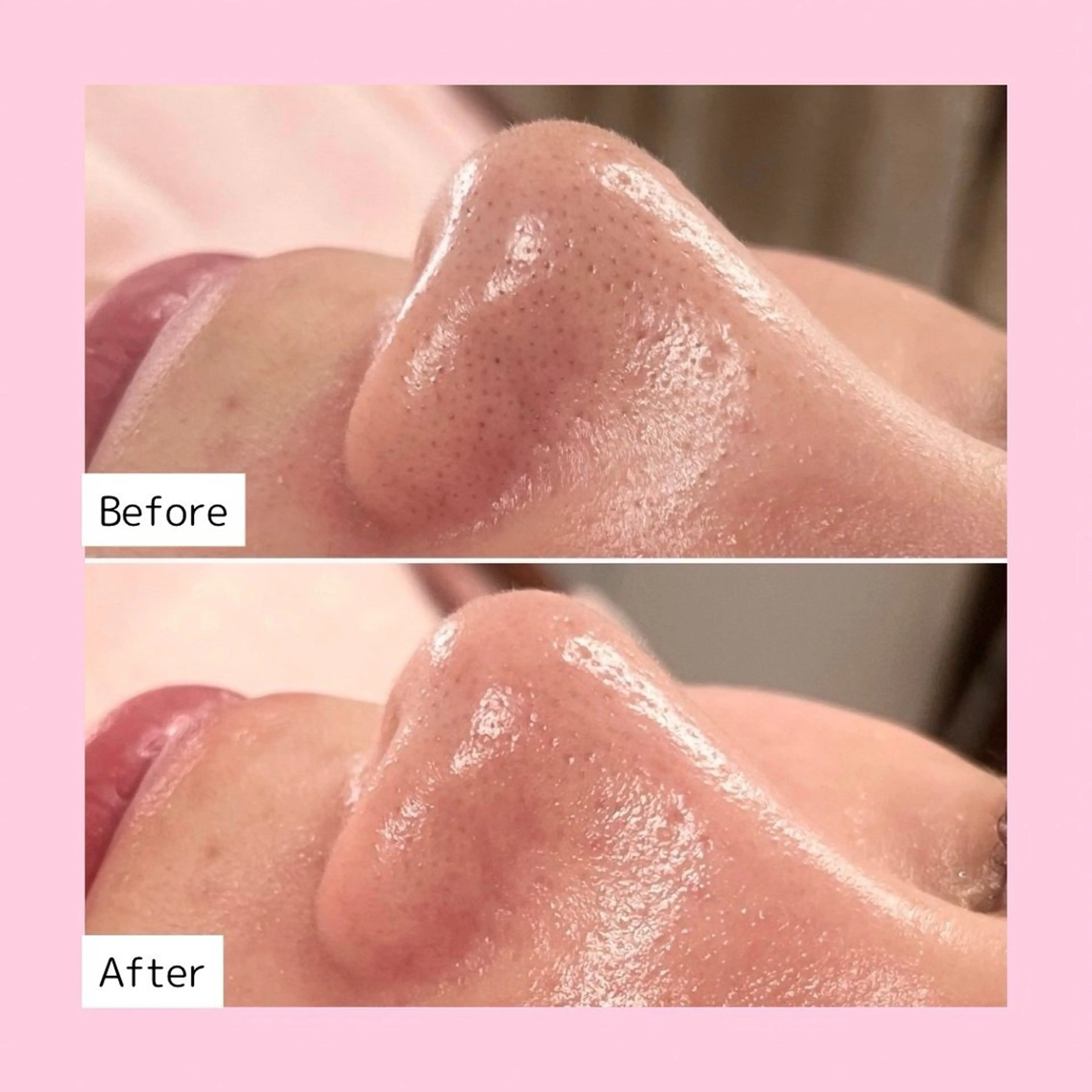 【水光肌パック仕上げ/保湿･菌活】毛穴洗浄 ハイドロフェイシャルの写真