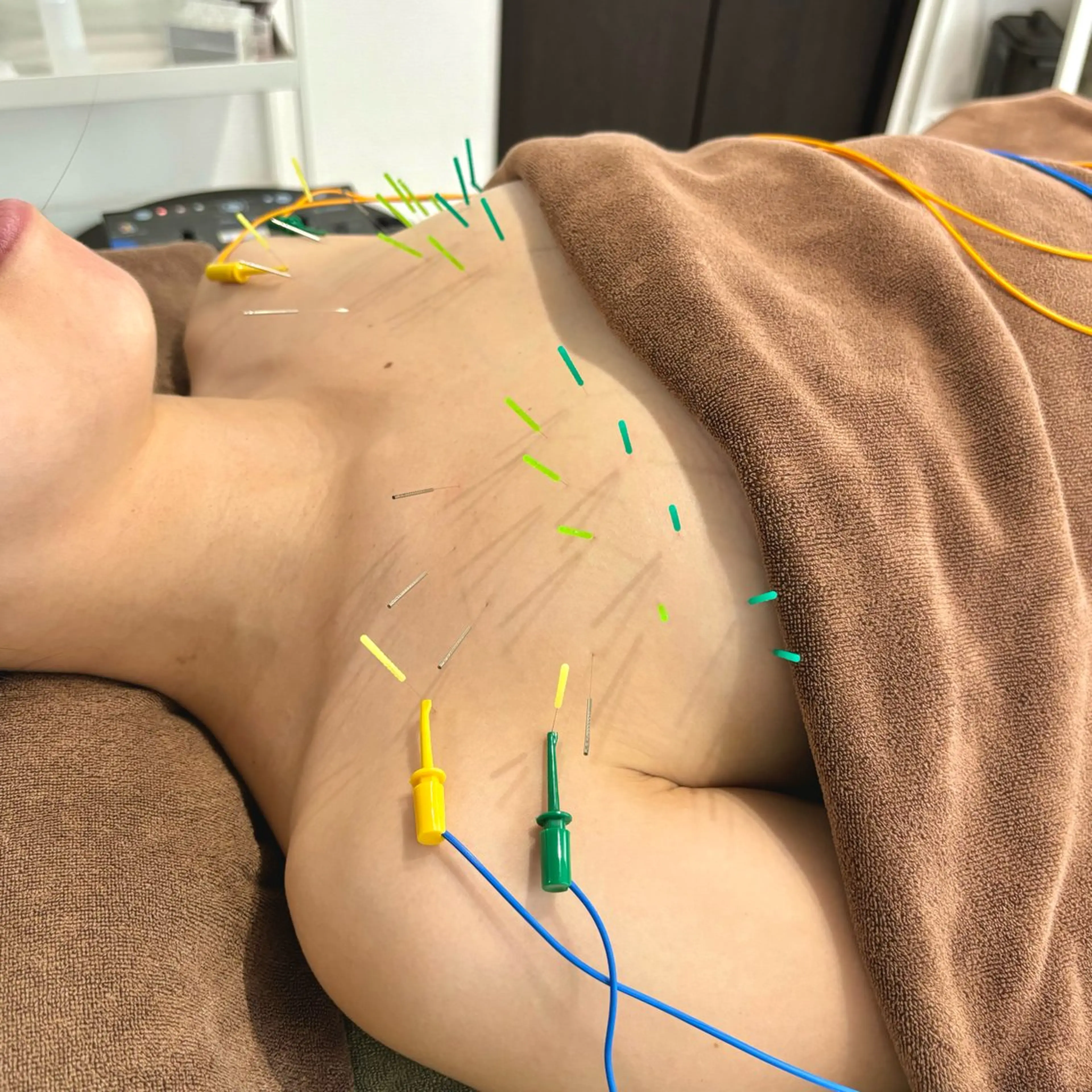 【バストアップ/ボリューム・ハリ感アップ】バストアップ美乳鍼の写真