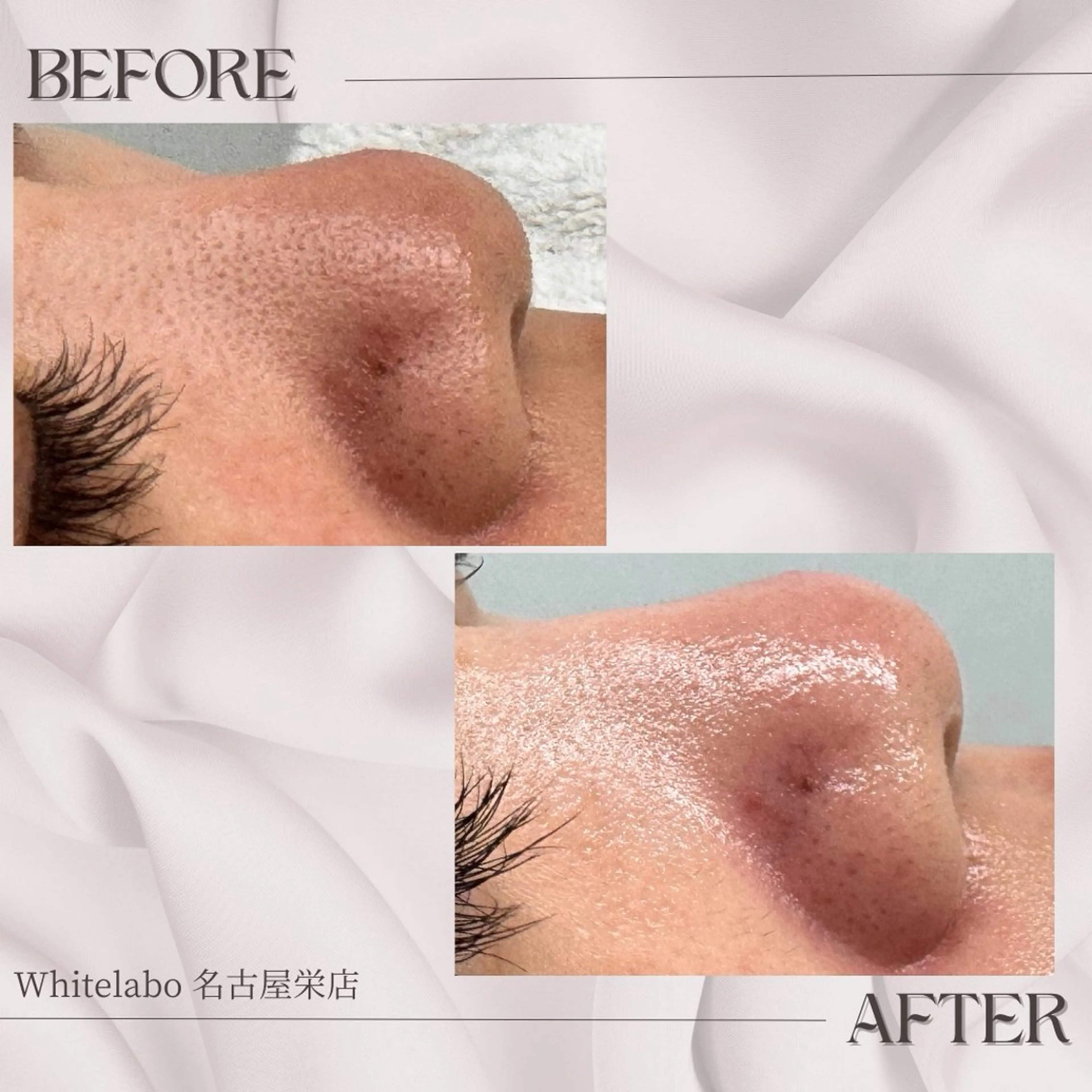 【白玉艶肌パック仕上げ/美白】毛穴洗浄ハイドロフェイシャル🚿の写真