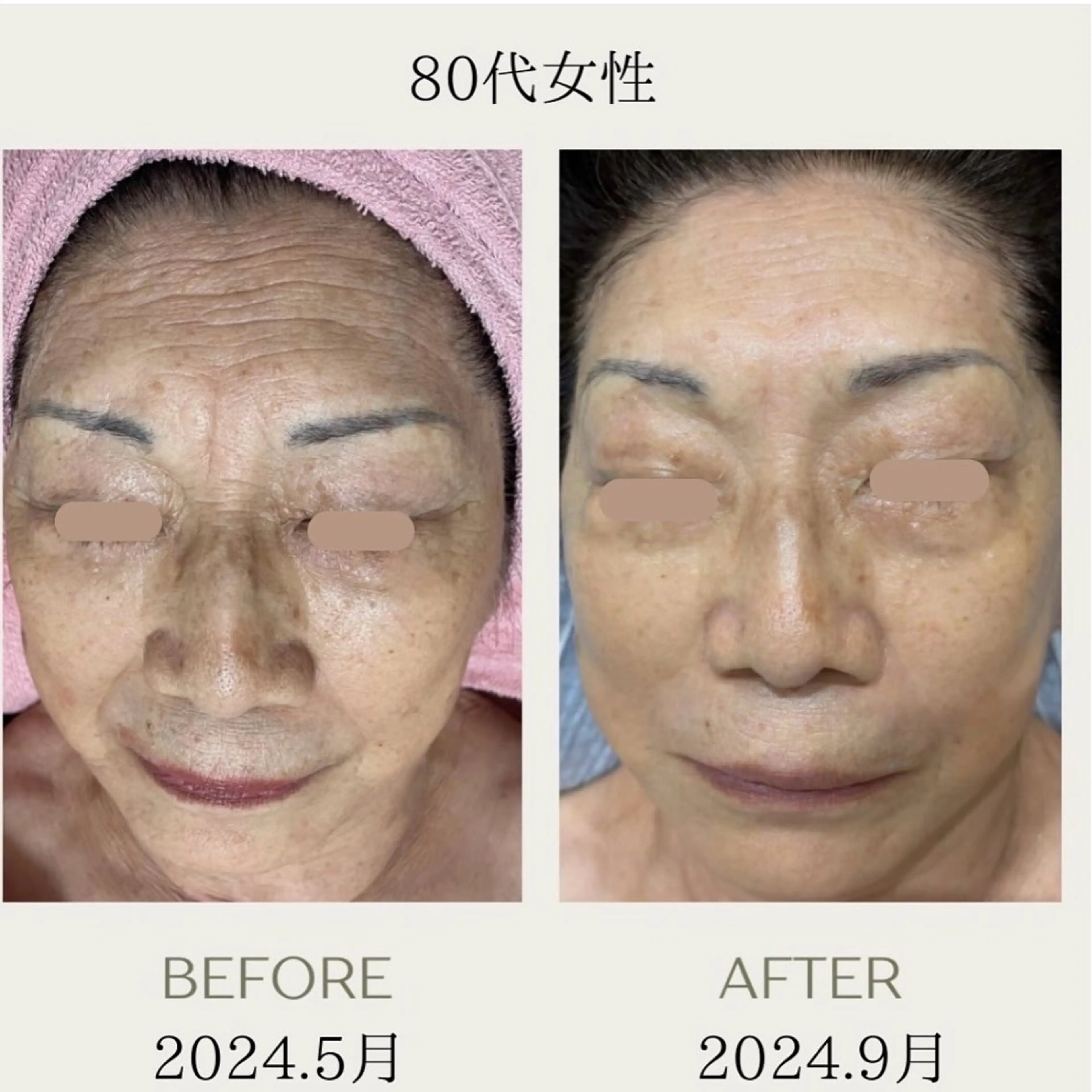 ピーリングケア 🤍moekoのエステ・リラクイメージ