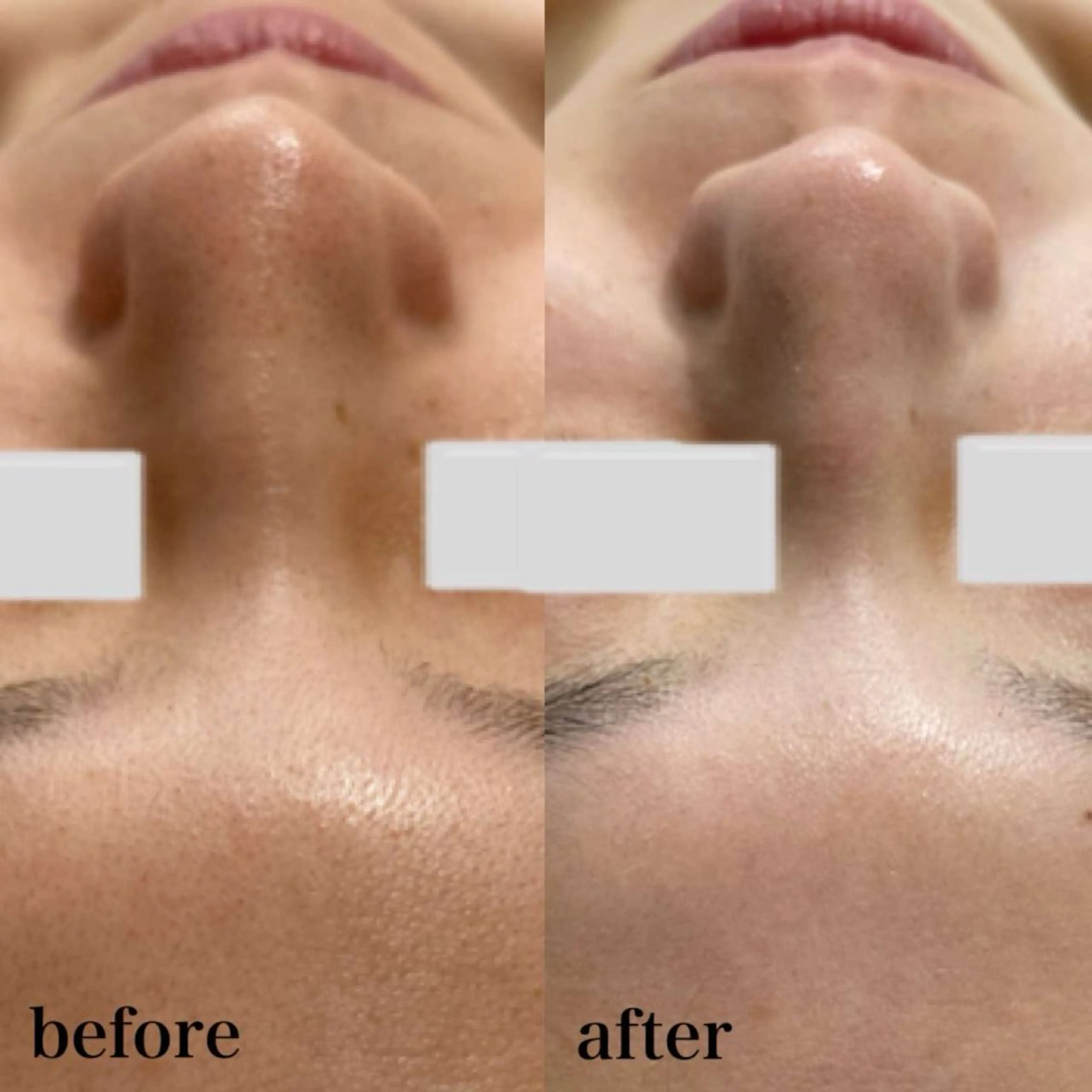 ハーブピーリング/韓国肌管理/フェイシャル/毛穴洗浄/眉毛/顔脱毛【糸脱毛専門】rev所属・ハーブピーリング🌹 毛穴洗浄❤️眉waxのエステ・リラクイメージ