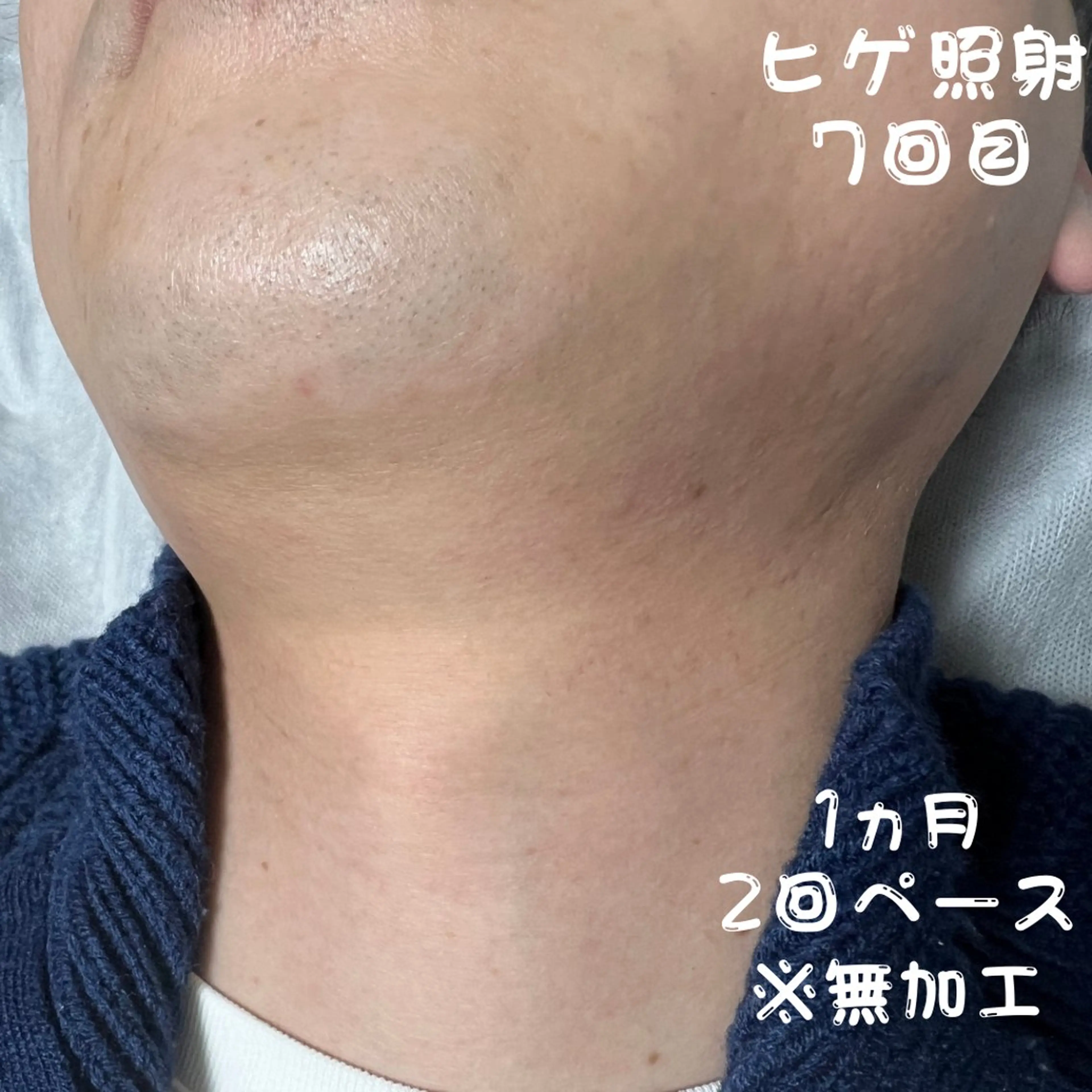 メンズ キッズ 脱毛 メンズ脱毛　FELISSE【フェリッセ】所属・メンズ脱毛フェリッセ /男女🆗キッズ🆗のエステ・リラクイメージ