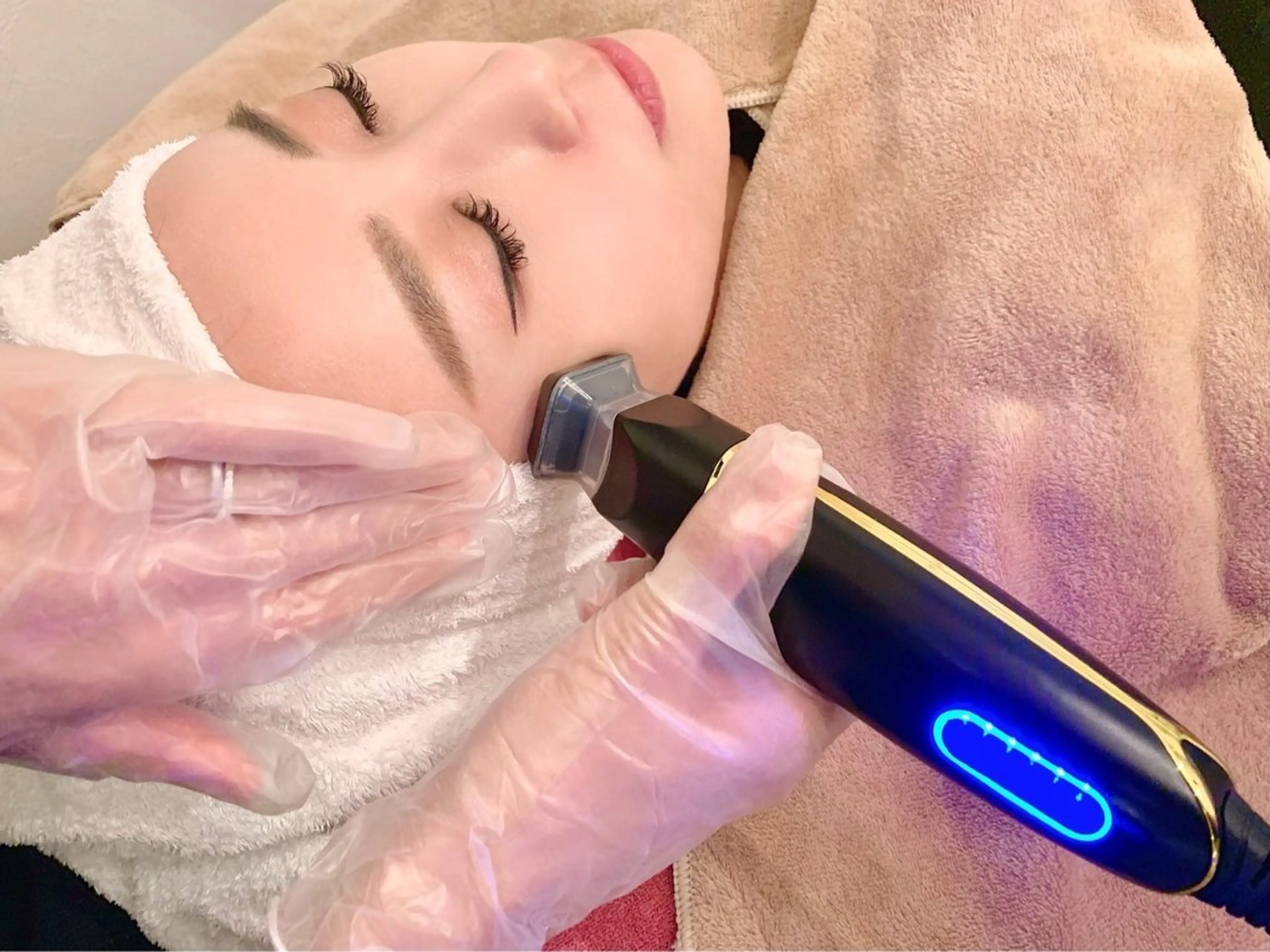 【お顔の脂肪、たるみ撃退】瞬間リフトアップ切らないVリフトの写真