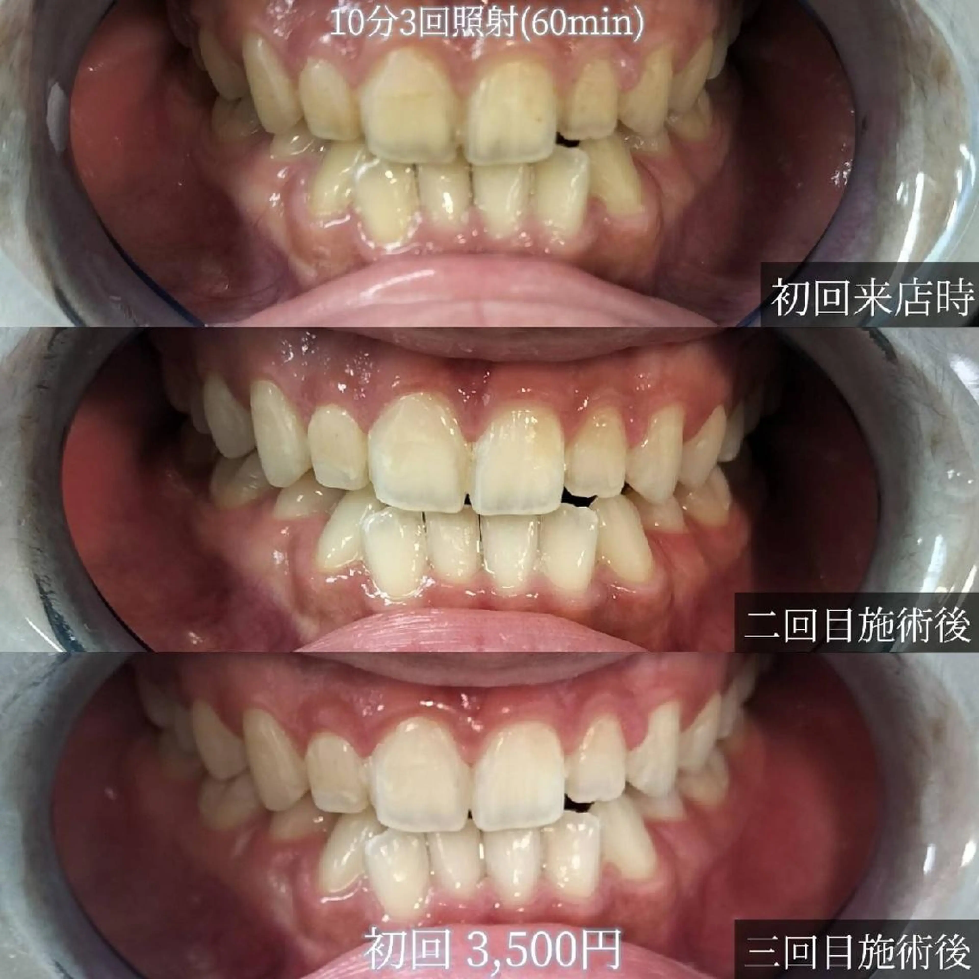 プレミアムホワイトニング🖤50分→60分照射¥5000🖤オプション無料グレードアップの写真