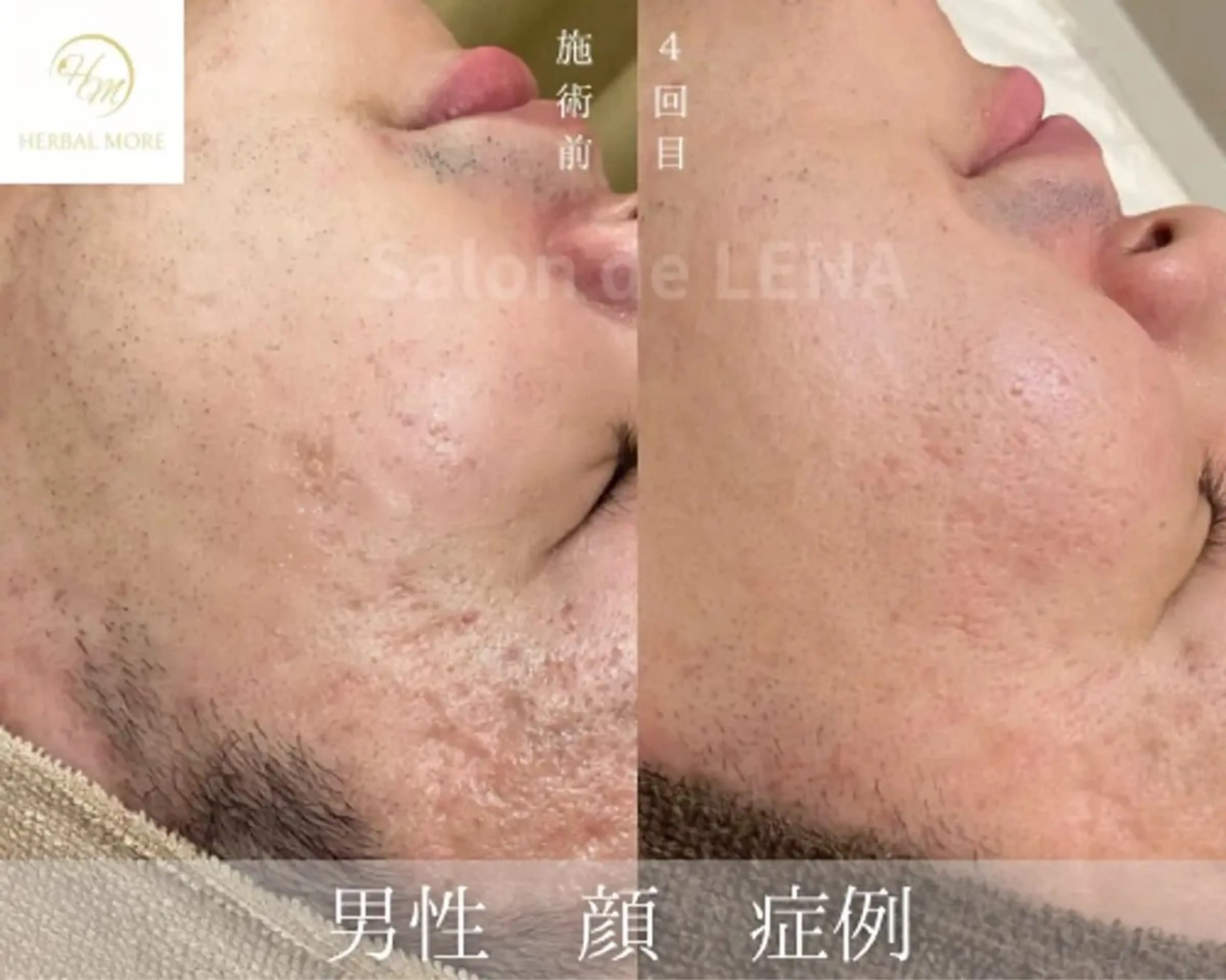 Grandir所属・ハーブピーリング専門 グランディール　武内のエステ・リラクイメージ