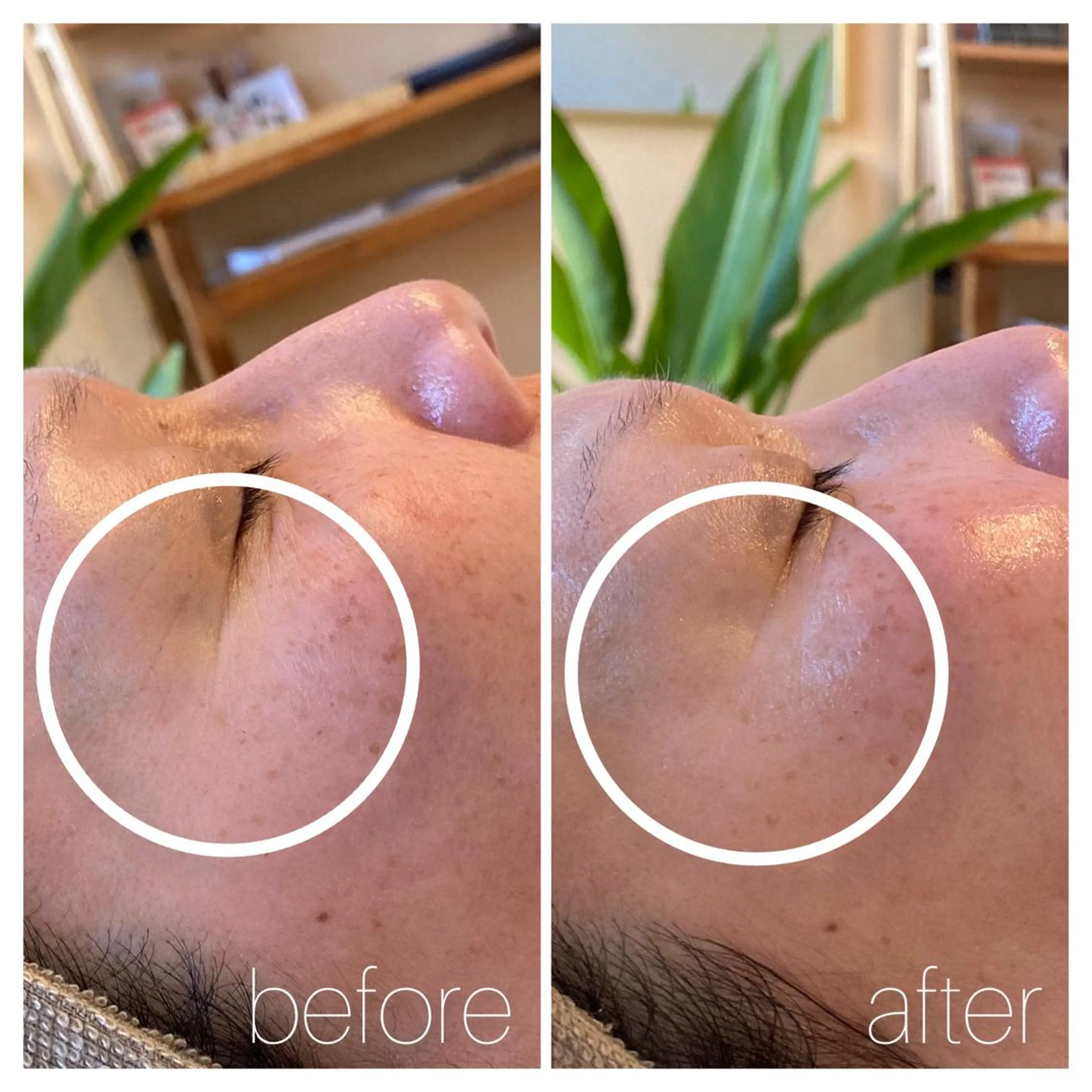 【ハリ、ツヤ激変！肌質改善】　　　　　　　　　　　　　　　　　　　　　ハーブピーリングでツヤ肌を手に入れよう♪の写真