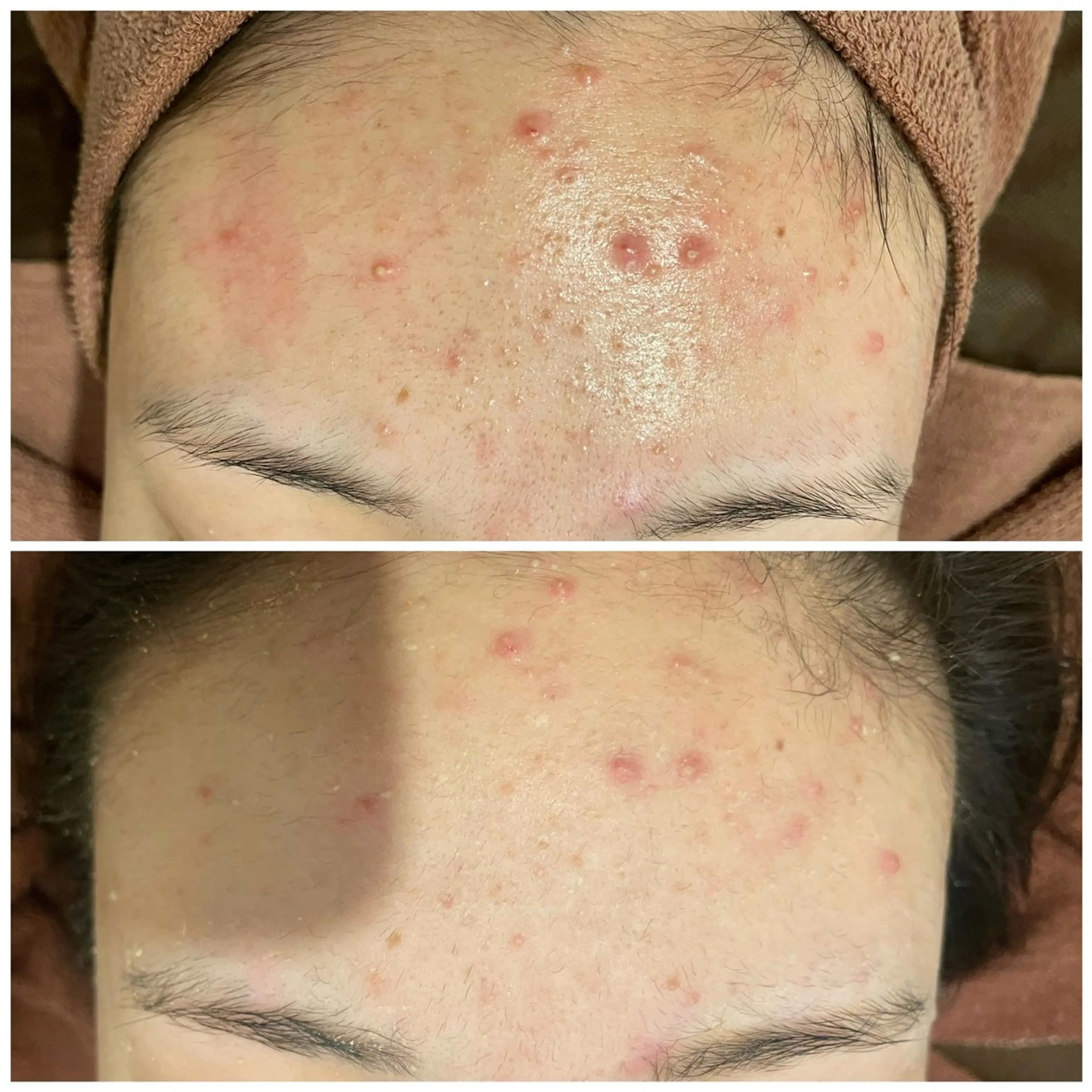 ニキビ特化型エステ 🍓最短で肌質改善のその他イメージ