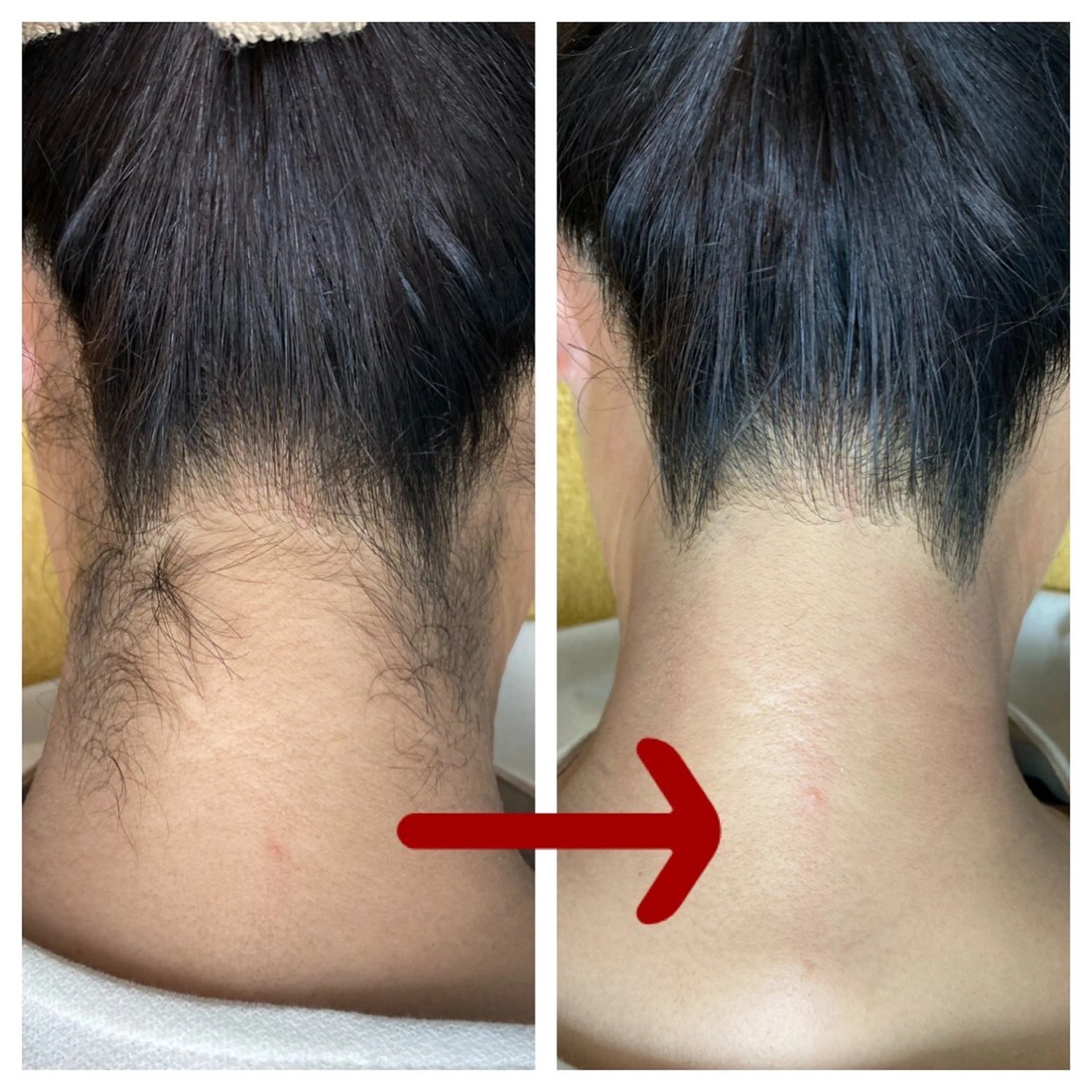 【ミニモ限定】人気No.1☆うなじ脱毛の写真