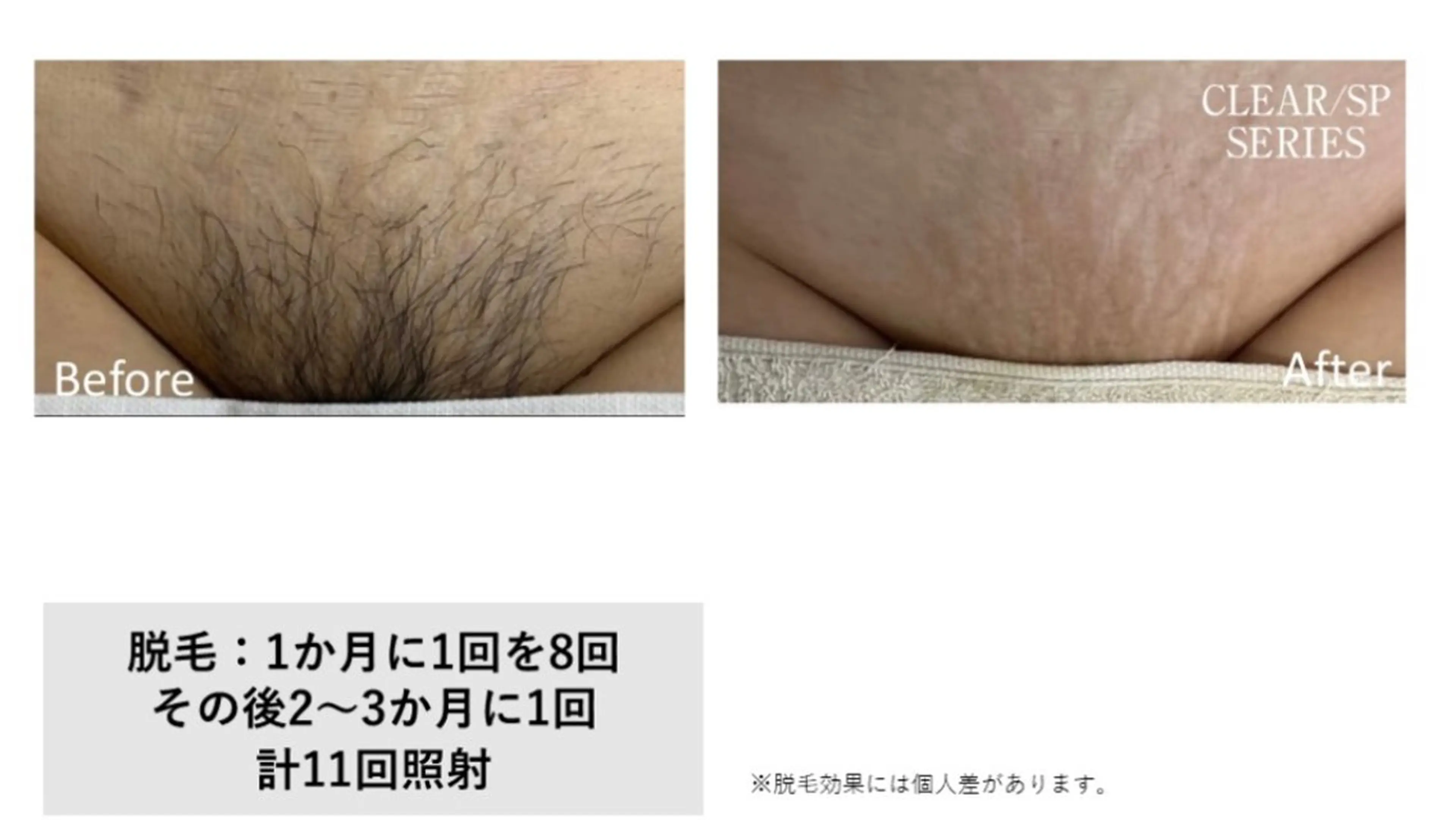 【国内産】NBS美容全身脱毛VIO《女性限定メニュー》の写真