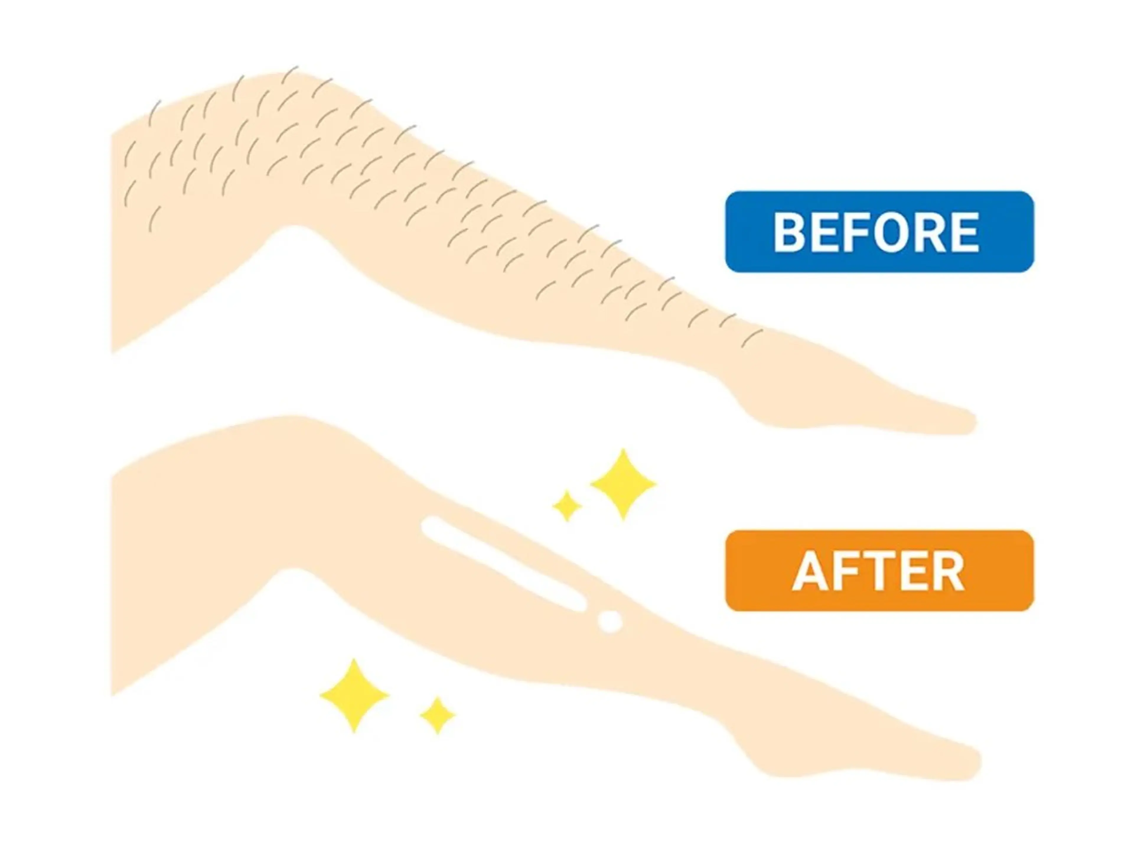 【2026年1月限定】メンズ全身脱毛（顔込み、VIOなし）事前シェービング込みの写真