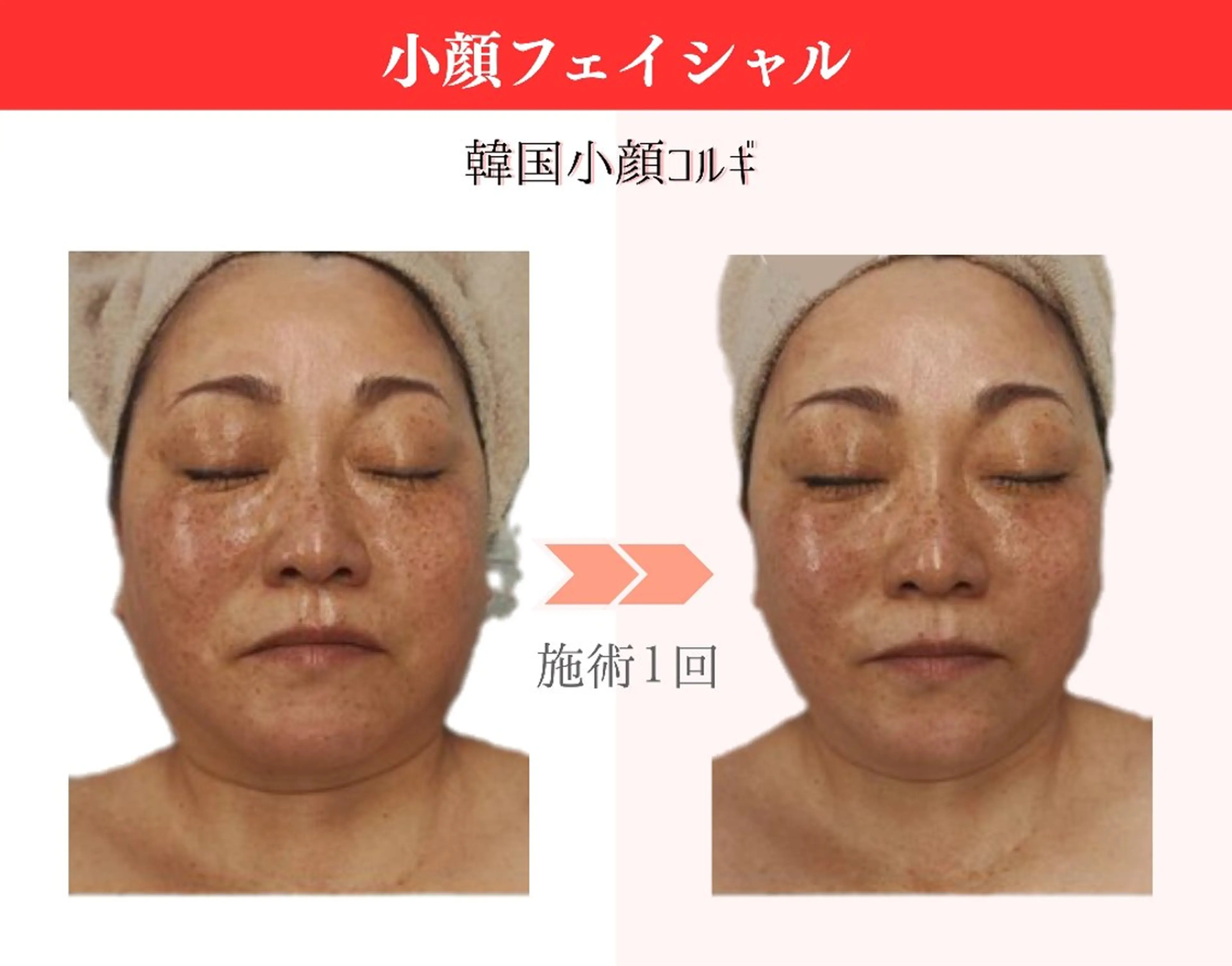 モニター特別価格♪小顔コルギ+ツヤパック60分の写真