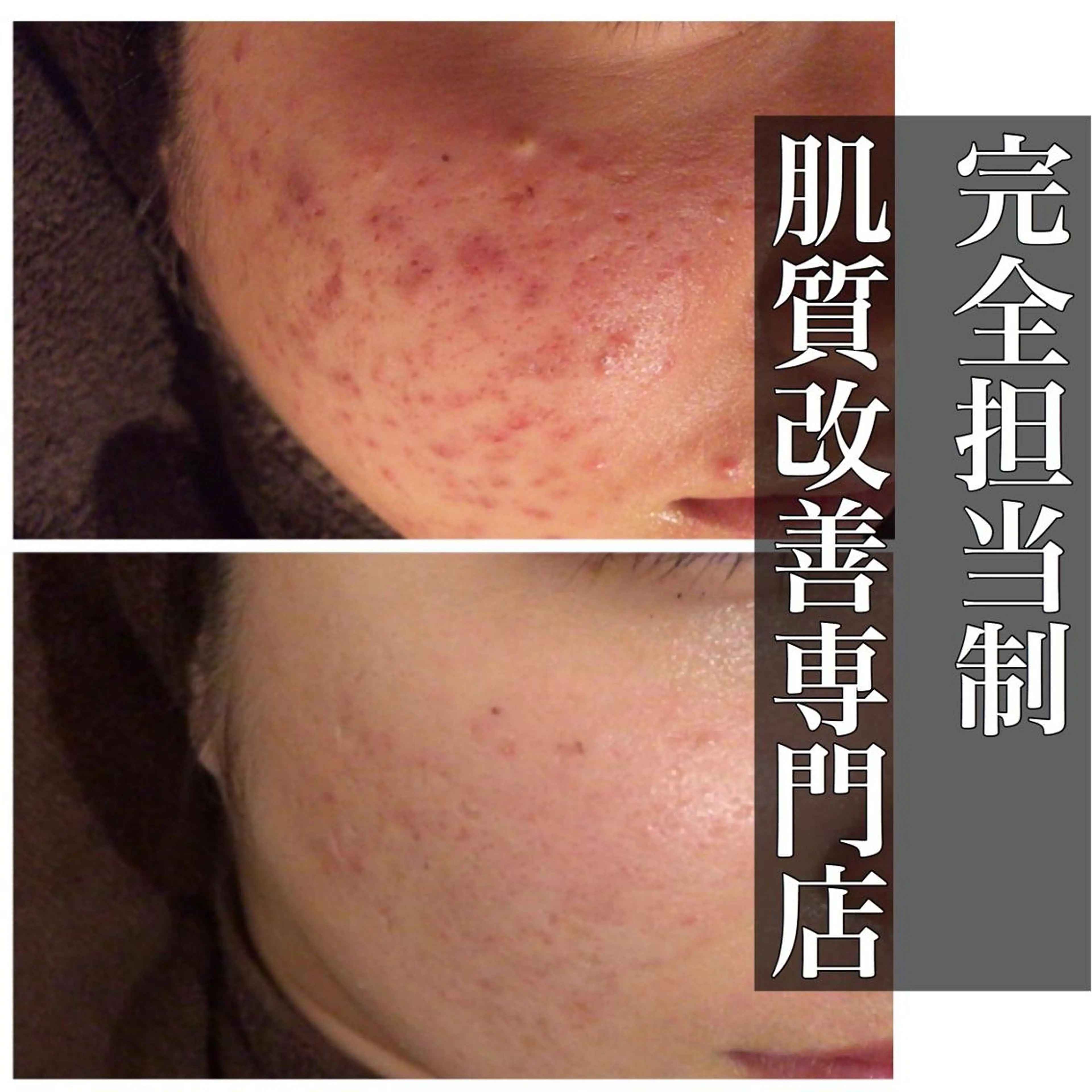 ニキビ特化型エステ 🍓最短で肌質改善のエステ・リラクイメージ