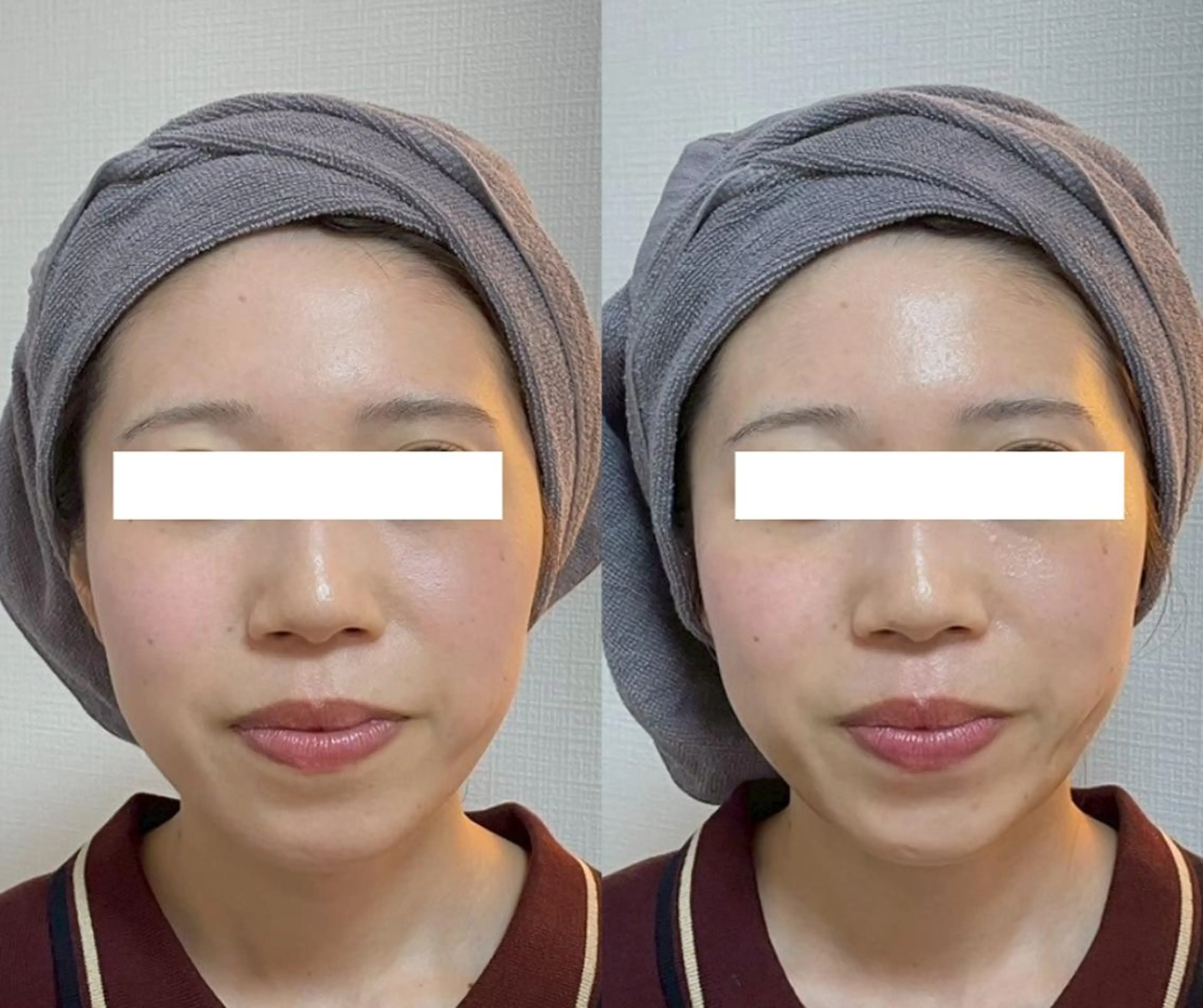 たるみケアの王道！指原さん愛用☆お試しサーマトリックス3部位の写真