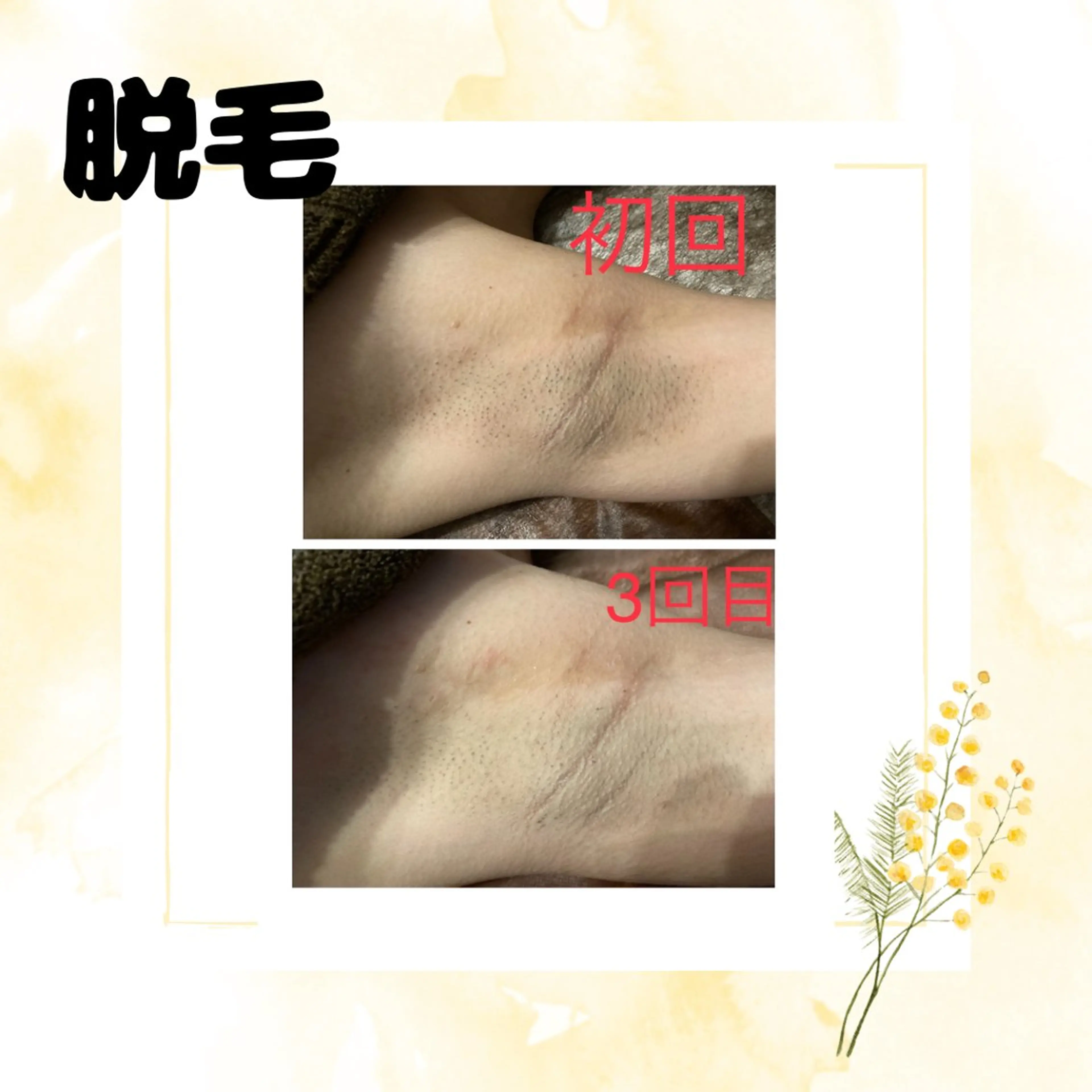 全身脱毛（顔&VIO込）クレンジング洗顔込み/通常価格￥23,000→円11,000の写真