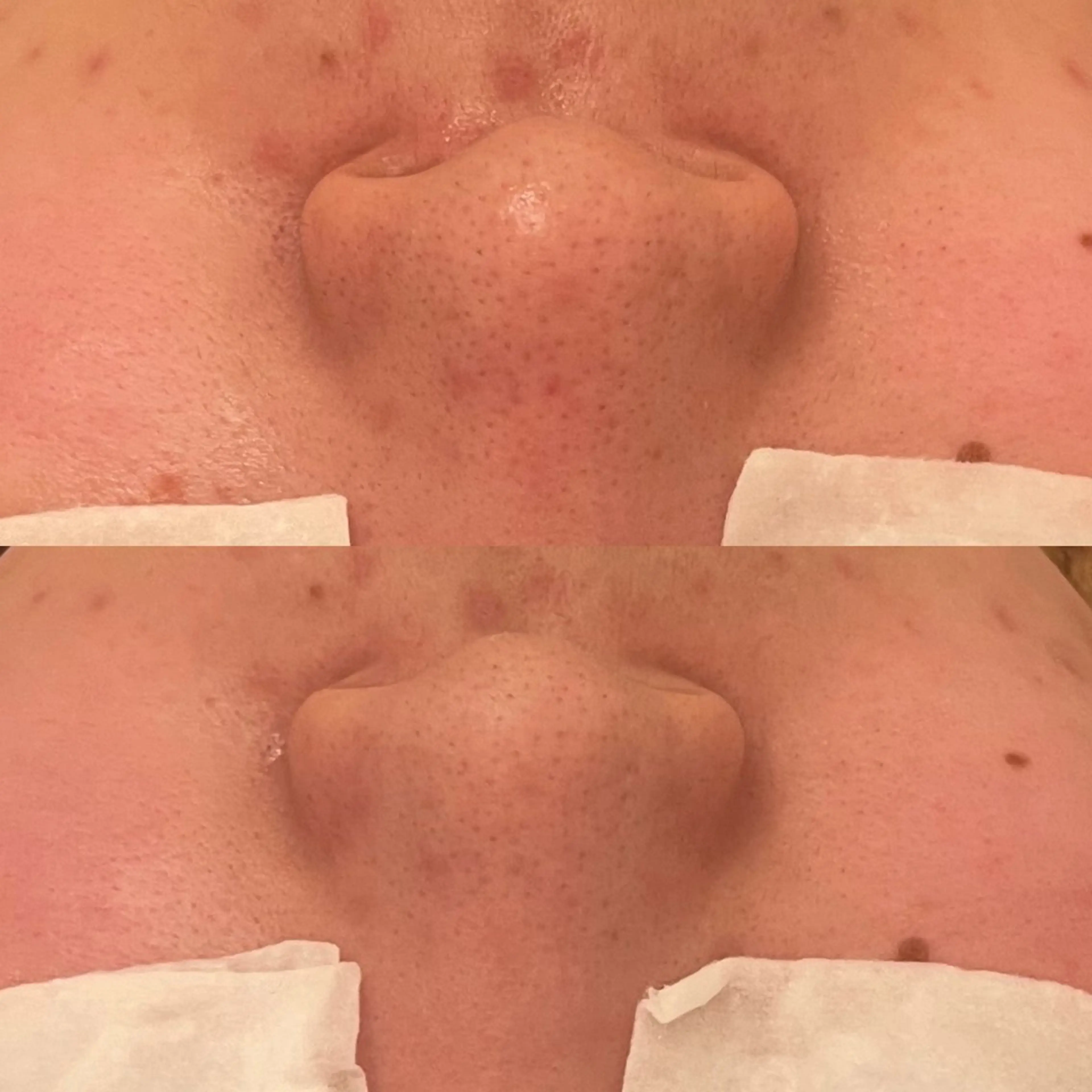 毛穴ケア/毛穴診断/ 毛穴洗浄〔心斎橋〕のエステ・リラクイメージ