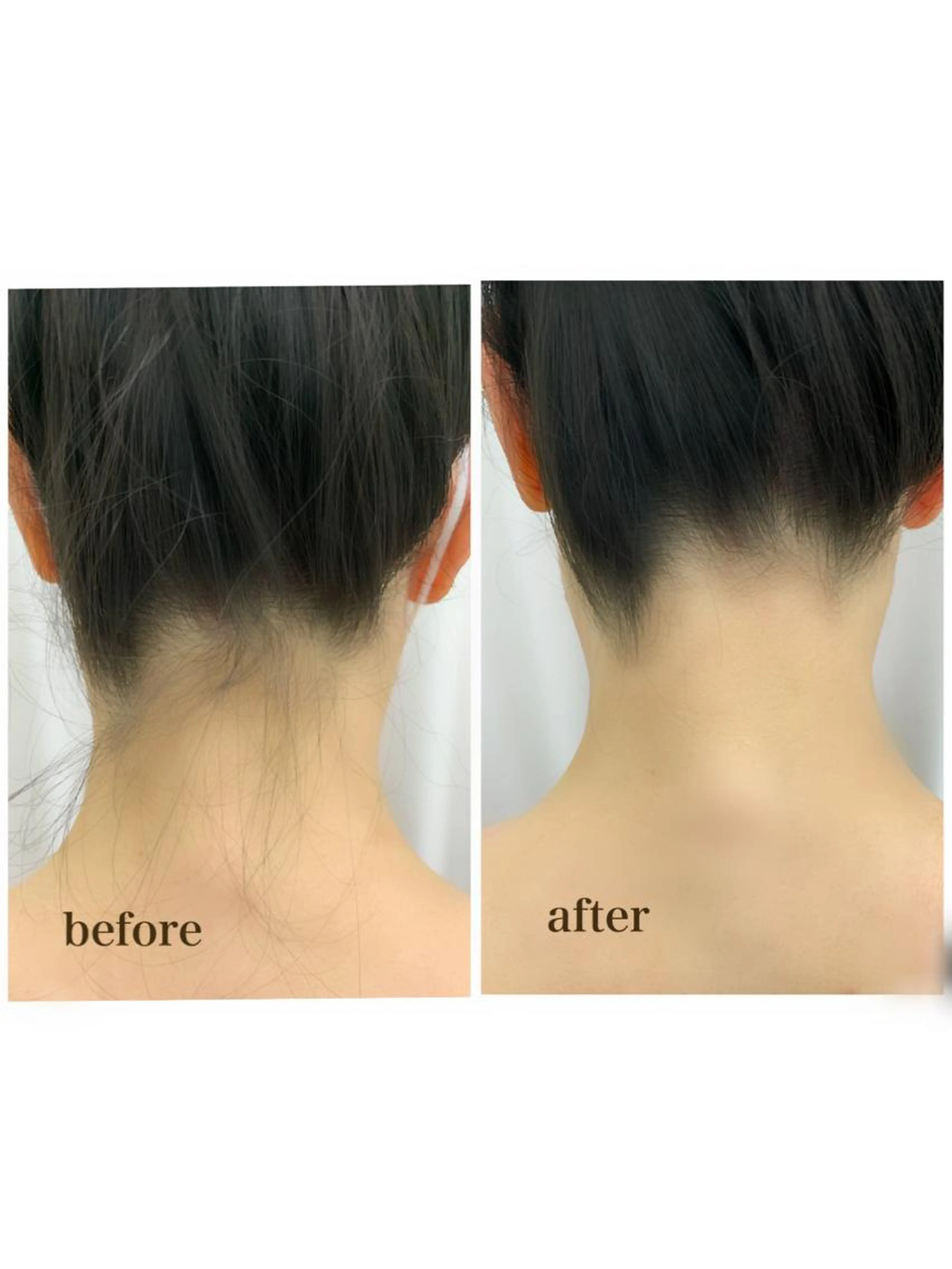 うなじ脱毛お試し（毛剃り、スタッフ施術あり）の写真