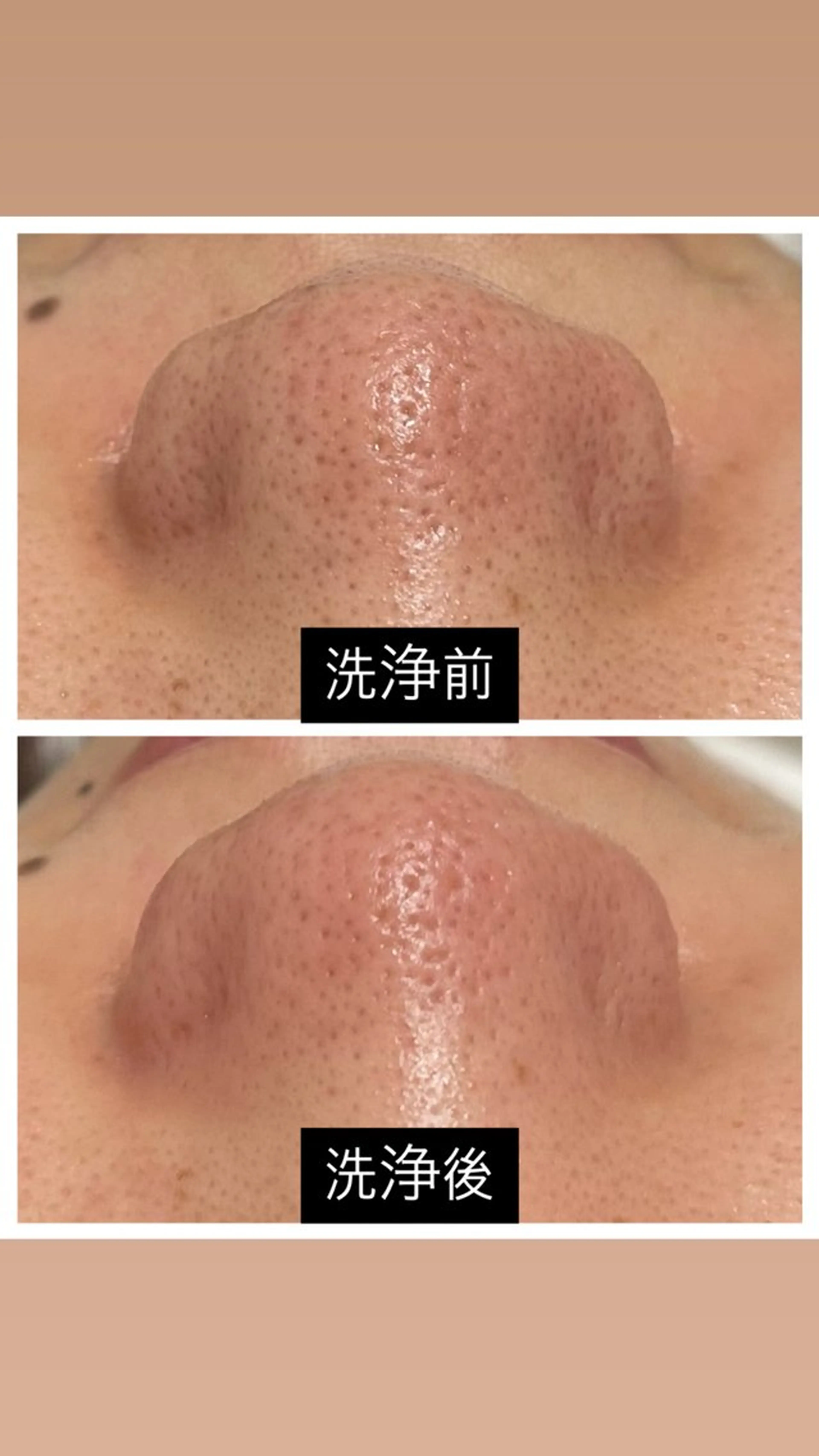 【ダウンタイム・剥離なし⠀】ハイドラフェイシャル・水流ピーリングの写真