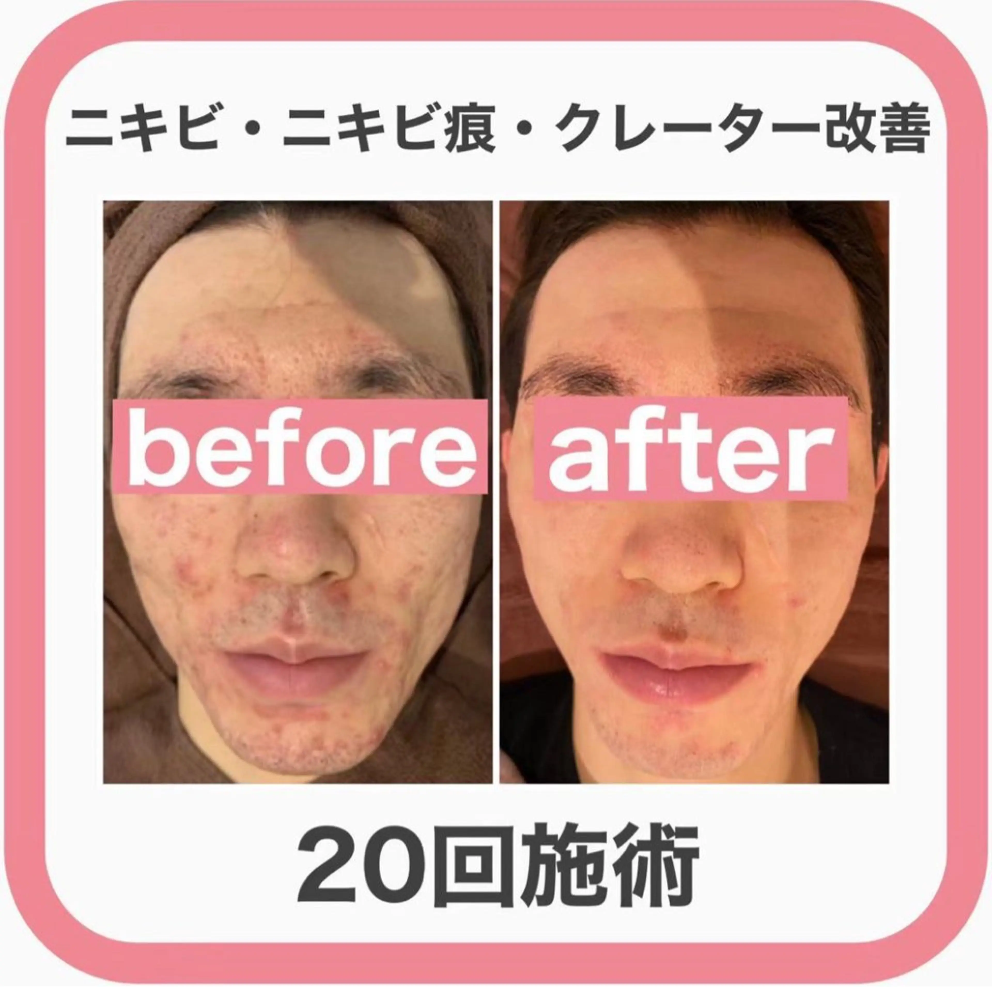 エステ リラク 学生ニキビ改善🍀 優しい肌質改善のエステ・リラクイメージ