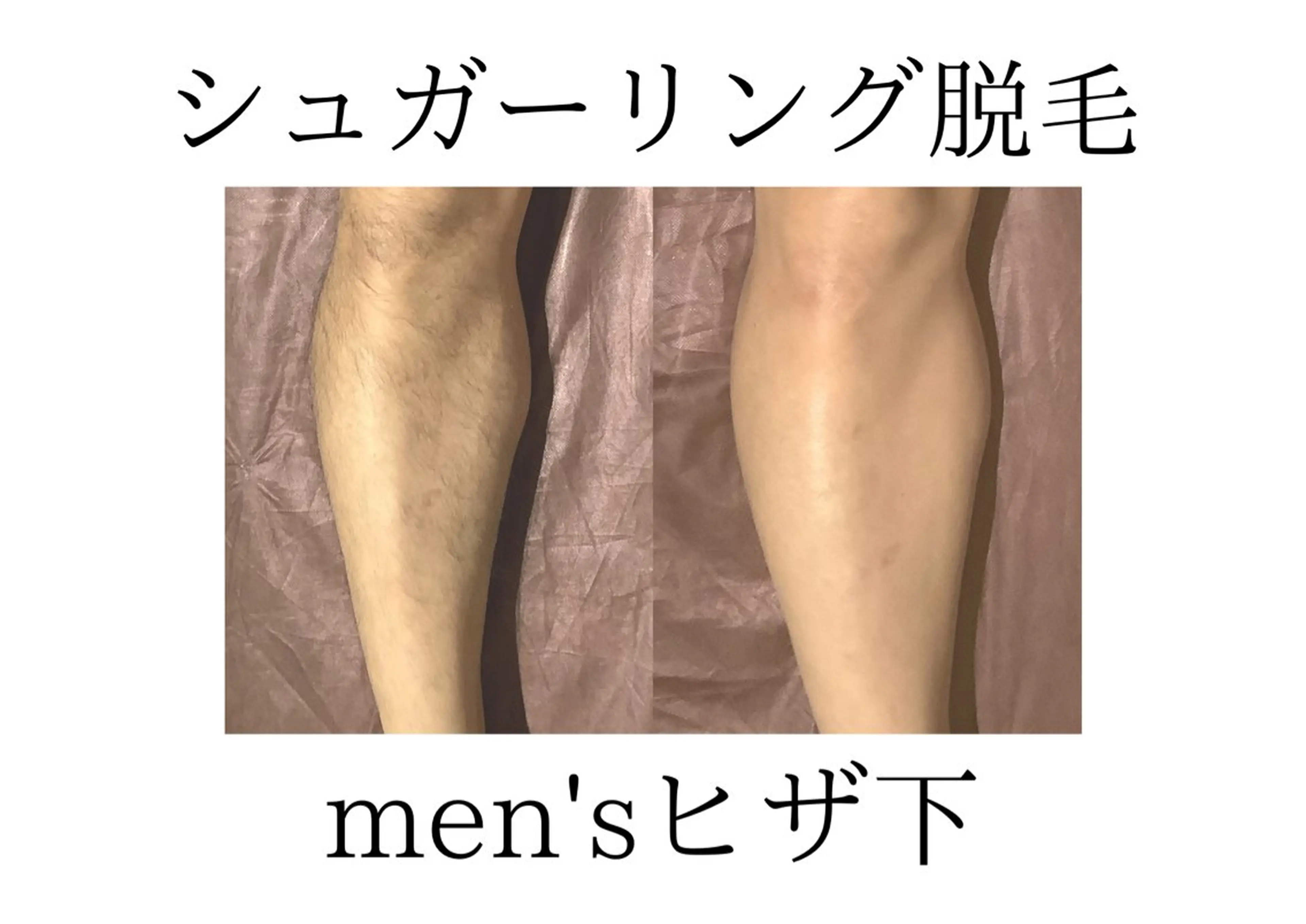 【メンズシュガーリング脱毛】 両ひざ下 ¥8000の写真