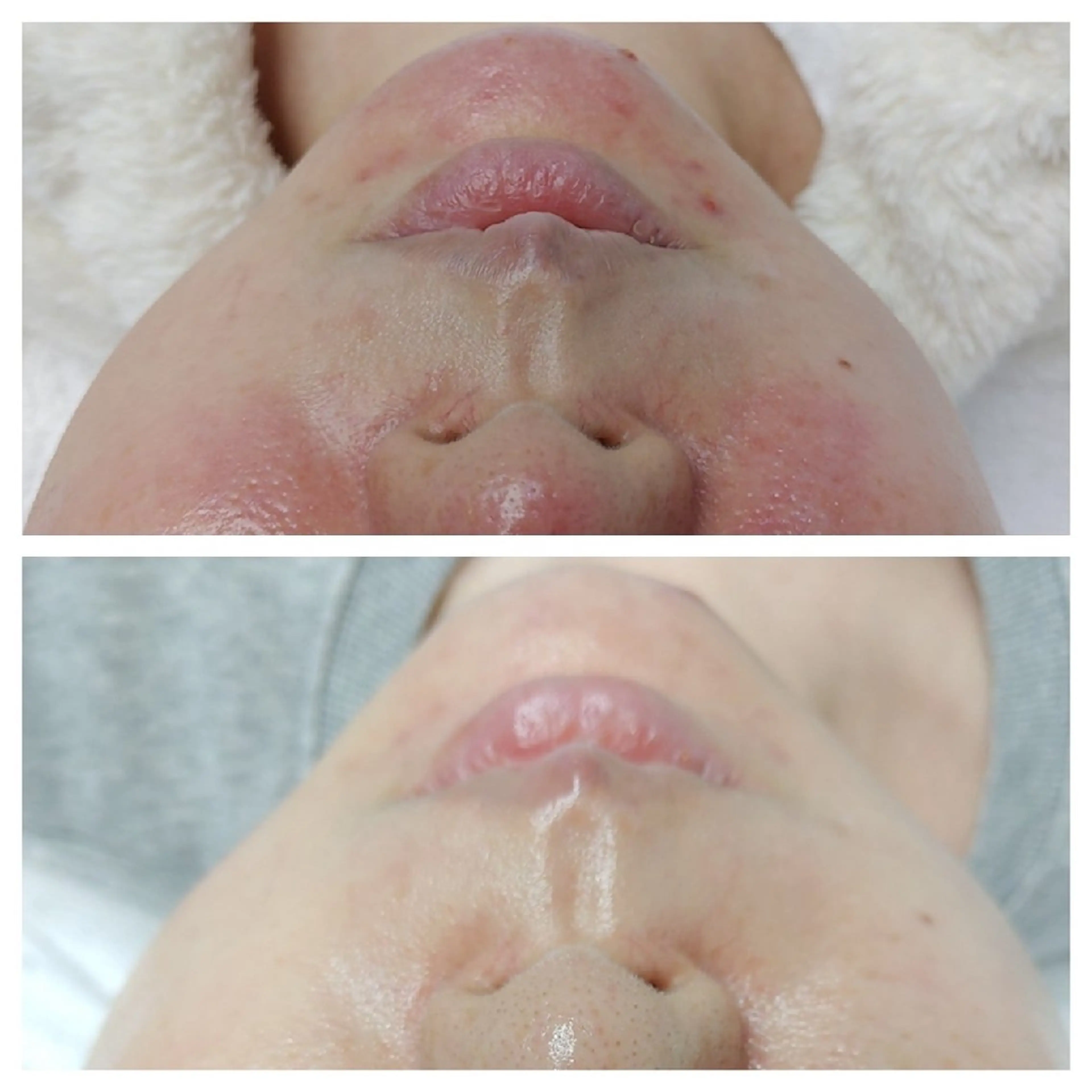 beauty & health salon Chou chou所属・ニキビ・毛穴🌿肌を 育てるララピール✨のエステ・リラクイメージ