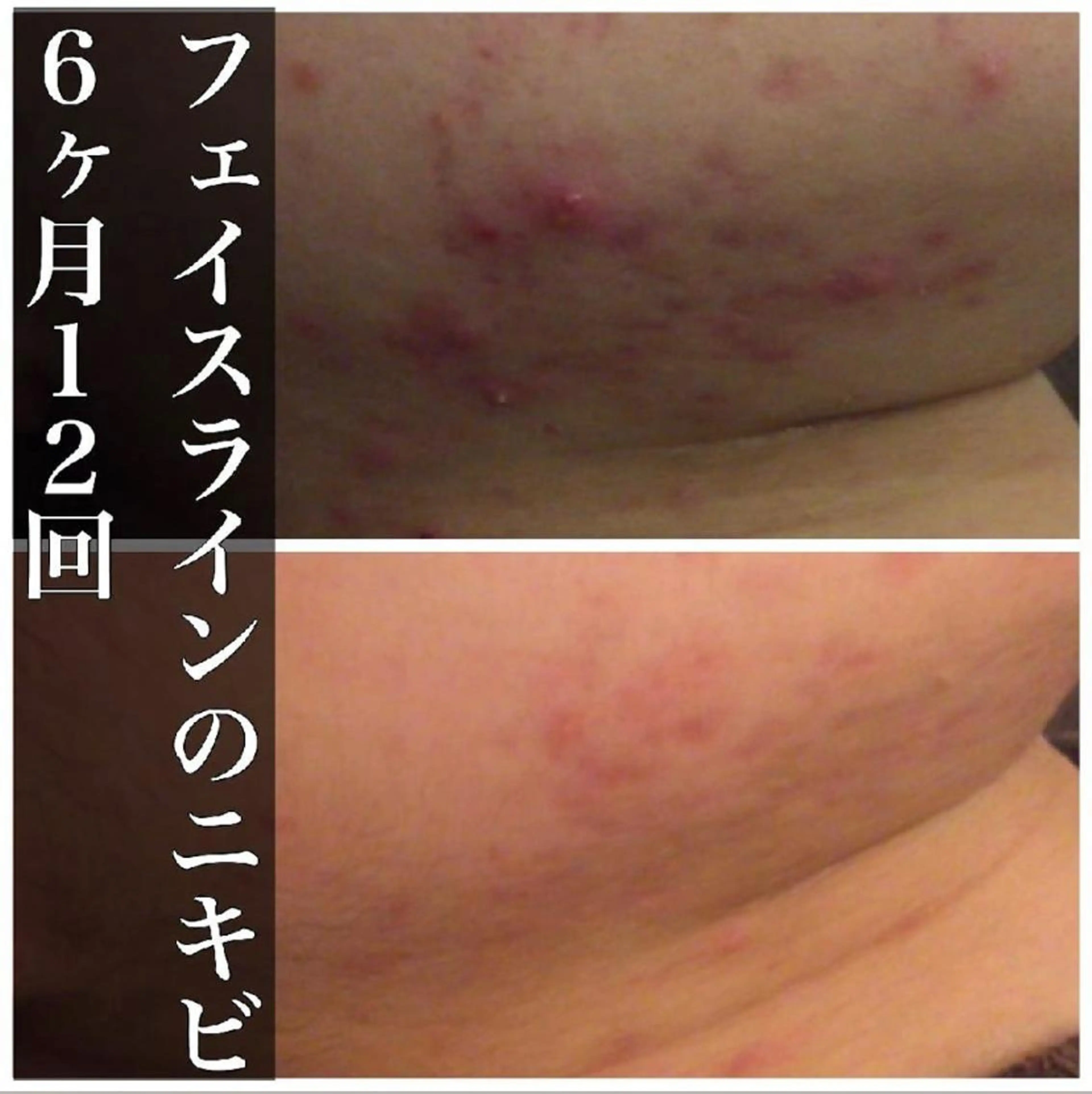 ショート カラー パーマ ヘアアレンジ メンズ キッズ ネイル マツエク・マツパ アイブロウ 夏までに肌荒れ卒業 するサロン🌻のエステ・リラクイメージ