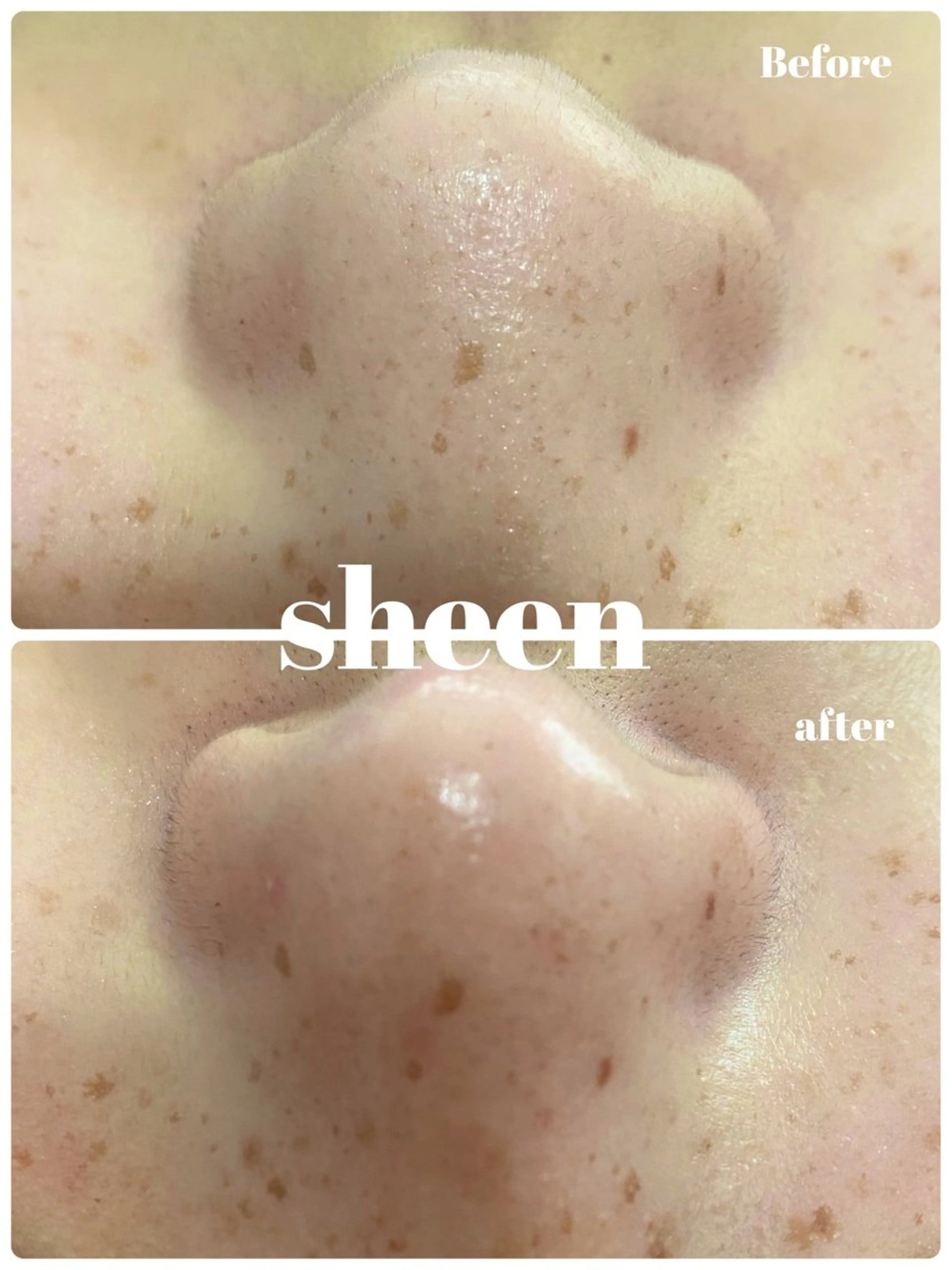 エステ Chalon所属・REVI取扱・肌悩み 毛穴Chalonのエステ・リラクイメージ