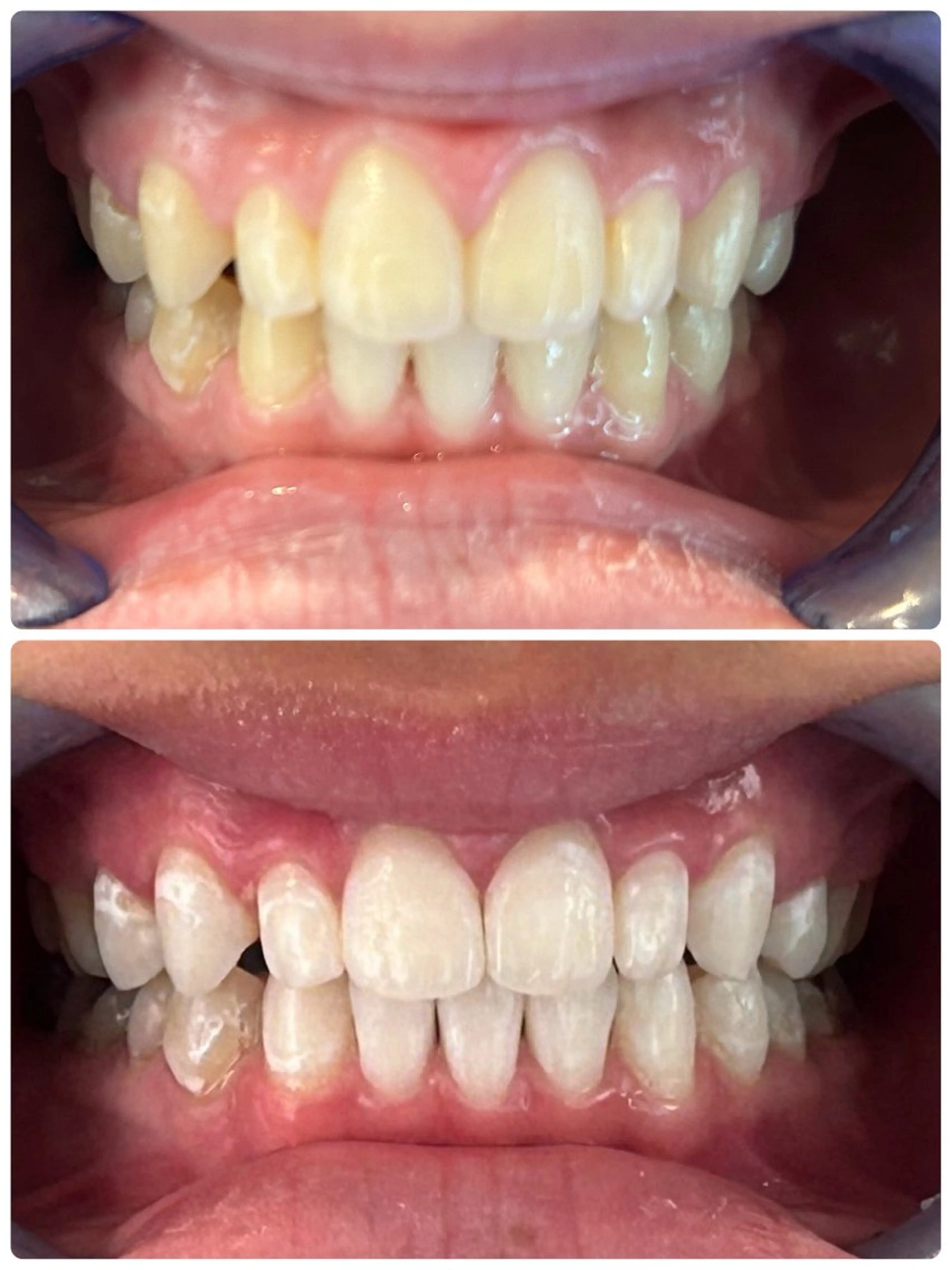 歯のセルフホワイトニング専門店GLOW(グロウ)所属・東区香椎歯のセルフホ ワイトニングGLOWのその他イメージ