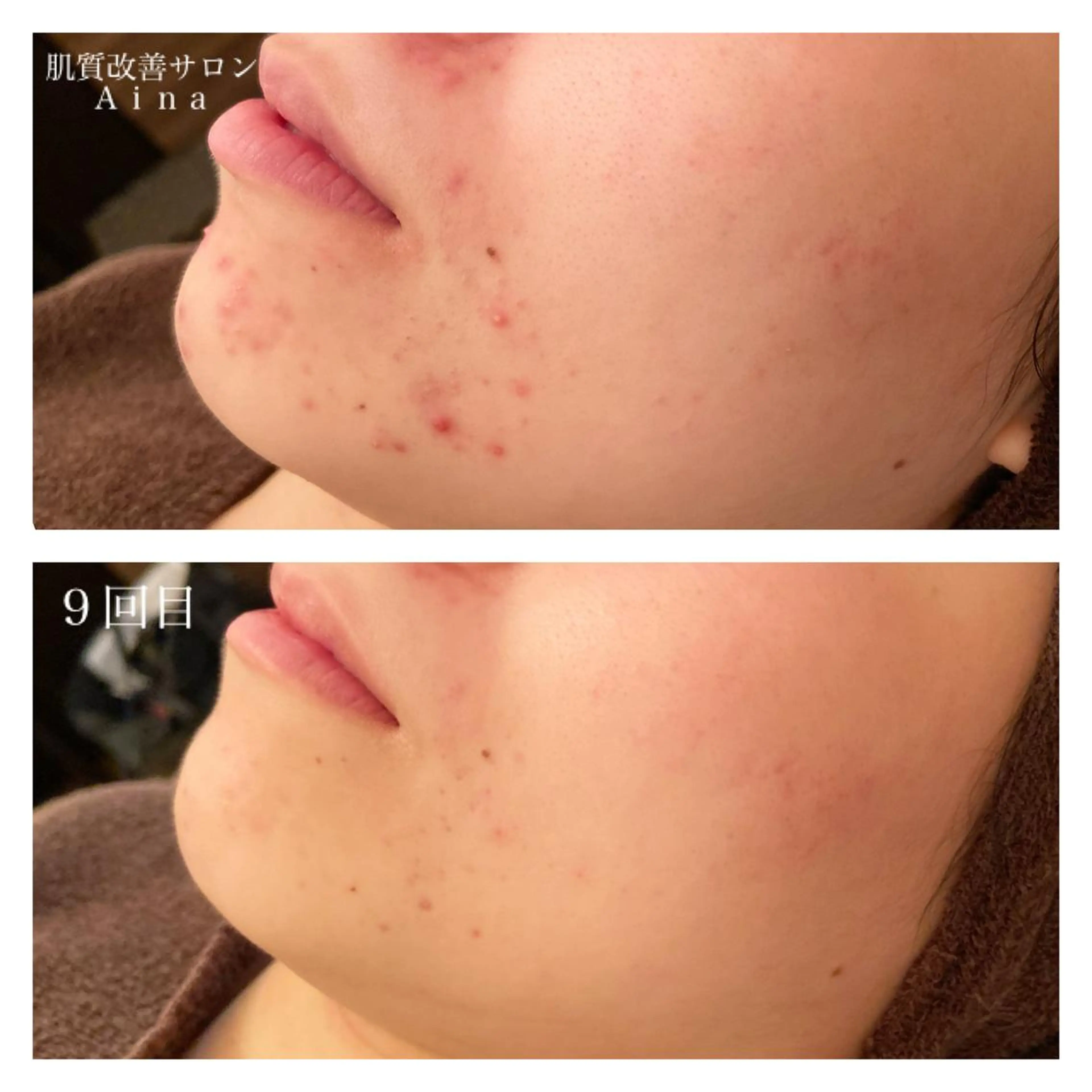 セミロング カラー パーマ ヘアアレンジ メンズ ネイル マツエク・マツパ エステ リラク ニキビ跡専門サロン Ａｉｎａのエステ・リラクイメージ